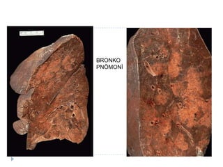 BRONKO
PNÖMONĠ
 