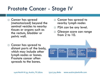 Prostate Cancer - Stage IV
¨  Cancer has spread
(metastasized) beyond the
seminal vesicles to nearby
tissues or organs such as
the rectum, bladder or
pelvic wall.
¨  Cancer has spread to
distant parts of the body,
which may include other
lymph nodes or bones.
Prostate cancer often
spreads to the bones.
¨  Cancer has spread to
nearby lymph nodes
¨  PSA can be any level.
¨  Gleason score can range
from 2 to 10.
1400	
  North	
  IH	
  35,	
  Austin,	
  TX	
  78701 	
   	
  (512)	
  324-­‐8060 	
  www.austincyberknife.com	
  
 