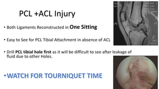 Anterior cruciate ligament injuries | PPTX