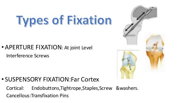 Anterior cruciate ligament injuries