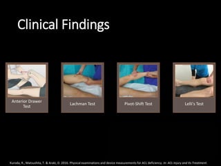 Clinical Findings
Anterior Drawer
Test
Lachman Test Pivot-Shift Test Lelli's Test
Kuroda, R., Matsushita, T. & Araki, D. 2016. Physical examinations and device measurements for ACL deficiency. In: ACL Injury and Its Treatment.
 