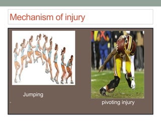 Mechanism of injury
Jumping
• pivoting injury
 