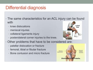 Differential diagnosis
• The same characteristics for an ACL injury can be found
with
• knee dislocations
• meniscal injuries
• collateral ligaments injury
• posterolateral corner injuries to the knee.
• Other problems that have to be considered are:
• patellar dislocation or fracture
• femoral, tibial or fibular fracture
• Bone contusion and micro fracture
 