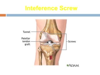 Anterior cruciate ligament-Injury & management | PPTX