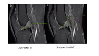 ACL CLINICAL AND RADIOLOGICAL DIAGNOSIS.pptx