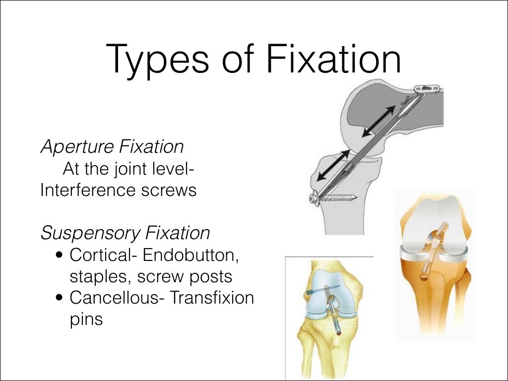 Acl graft fixation options