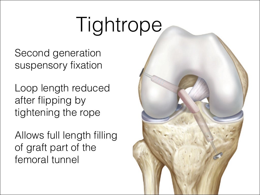 Acl graft fixation options