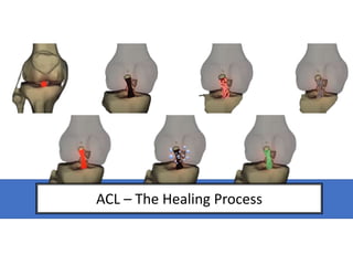 ACL – The Healing Process
 