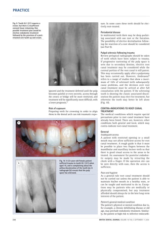 ignored and the treatment deferred until the pulp
becomes painful or even necrotic, access through
the crown or bridge will be more restricted, and
treatment will be significantly more difficult, with
a lower prognosis.5
Risk of exposure
Preparing teeth for crowning in order to align
them in the dental arch can risk traumatic expo-
sure. In some cases these teeth should be elec-
tively root-treated.
Periodontal disease
In multirooted teeth there may be deep pocket-
ing associated with one root or the furcation.
The possibility of elective devitalisation follow-
ing the resection of a root should be considered
(see Part 9).
Pulpal sclerosis following trauma
Review periapical radiographs should be taken
of teeth which have been subject to trauma.
If progressive narrowing of the pulp space is
seen due to secondary dentine, elective root
canal treatment may be considered while the
coronal portion of the root canal is still patent.
This may occasionally apply after a pulpotomy
has been carried out. However, Andreasen6
refers to a range of studies that show a maxi-
mum of 16% of sclerosed teeth subsequently
cause problems, and the decision over root
canal treatment must be arrived at after full
consultation with the patient. If the sclerosing
tooth is showing the classic associated discol-
oration the patient may elect for treatment, but
otherwise the tooth may better be left alone
(Fig. 10).
CONTRA-INDICATIONS TO ROOT CANAL
TREATMENT
The medical conditions which require special
precautions prior to root canal treatment have
already been listed. There are, however, other
conditions both general and local, which may
contra-indicate root canal treatment.
General
Inadequate access
A patient with restricted opening or a small
mouth may not allow sufficient access for root
canal treatment. A rough guide is that it must
be possible to place two fingers between the
mandibular and maxillary incisor teeth so that
there is good visual access to the areas to be
treated. An assessment for posterior endodon-
tic surgery may be made by retracting the
cheek with a finger. If the operation site can
be seen directly with ease, then the access is
sufficient.
Poor oral hygiene
As a general rule root canal treatment should
not be carried out unless the patient is able to
maintain his/her mouth in a healthy state, or
can be taught and motivated to do so. Excep-
tions may be patients who are medically or
physically compromised, but any treatment
afforded should always be in the best long-term
interests of the patient.
Patient’s general medical condition
The patient’s physical or mental condition due to,
for example, a chronic debilitating disease or old
age, may preclude endodontic treatment. Similar-
ly, the patient at high risk to infective endocardi-
Fig. 10 A 23-year-old female patient
suffered trauma to tooth UL1 (21) when
aged 16, and is complaining about the
yellow discoloration of the tooth (a). A
radiograph (b) reveals that the pulp
space has sclerosed.
a
b
Fig. 9 Tooth UL1 (21) requires a
crown, but there is insufficient
coronal tissue remaining. One
possible treatment plan would be
elective endodontic treatment
followed by the provision of a post-
retained core build-up and crown.
236 BRITISH DENTAL JOURNAL VOLUME 197 NO. 5 SEPTEMBER 11 2004
PRACTICE
05p231-238.qxd 12/08/2004 11:59 Page 236
 
