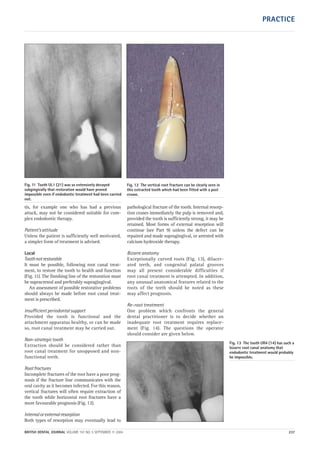tis, for example one who has had a previous
attack, may not be considered suitable for com-
plex endodontic therapy.
Patient’s attitude
Unless the patient is sufficiently well motivated,
a simpler form of treatment is advised.
Local
Toothnotrestorable
It must be possible, following root canal treat-
ment, to restore the tooth to health and function
(Fig. 11). The finishing line of the restoration must
be supracrestal and preferably supragingival.
An assessment of possible restorative problems
should always be made before root canal treat-
ment is prescribed.
Insufficient periodontal support
Provided the tooth is functional and the
attachment apparatus healthy, or can be made
so, root canal treatment may be carried out.
Non-strategic tooth
Extraction should be considered rather than
root canal treatment for unopposed and non-
functional teeth.
Rootfractures
Incomplete fractures of the root have a poor prog-
nosis if the fracture line communicates with the
oral cavity as it becomes infected. For this reason,
vertical fractures will often require extraction of
the tooth while horizontal root fractures have a
more favourable prognosis (Fig. 12).
Internalorexternalresorption
Both types of resorption may eventually lead to
pathological fracture of the tooth. Internal resorp-
tion ceases immediately the pulp is removed and,
provided the tooth is sufficiently strong, it may be
retained. Most forms of external resorption will
continue (see Part 9) unless the defect can be
repaired and made supragingival, or arrested with
calcium hydroxide therapy.
Bizarre anatomy
Exceptionally curved roots (Fig. 13), dilacer-
ated teeth, and congenital palatal grooves
may all present considerable difficulties if
root canal treatment is attempted. In addition,
any unusual anatomical features related to the
roots of the teeth should be noted as these
may affect prognosis.
Re-root treatment
One problem which confronts the general
dental practitioner is to decide whether an
inadequate root treatment requires replace-
ment (Fig. 14). The questions the operator
should consider are given below.
Fig. 11 Tooth UL1 (21) was so extensively decayed
subgingivally that restoration would have proved
impossible even if endodontic treatment had been carried
out.
Fig. 12 The vertical root fracture can be clearly seen in
this extracted tooth which had been fitted with a post
crown.
Fig. 13 The tooth UR4 (14) has such a
bizarre root canal anatomy that
endodontic treatment would probably
be impossible.
BRITISH DENTAL JOURNAL VOLUME 197 NO. 5 SEPTEMBER 11 2004 237
PRACTICE
05p231-238.qxd 12/08/2004 12:00 Page 237
 