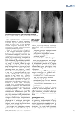 PRACTICE
BRITISH DENTAL JOURNAL VOLUME 197 NO. 6 SEPTEMBER 25 2004 301
Once pulpal inflammation has spread to the
periodontal ligament, the resulting inflammato-
ry exudate may cause extrusion of the tooth,
making it tender to bite on. This particular
symptom, acute apical periodontitis, may be a
consequence of occlusal trauma; the occlusion
must therefore always be checked.
Ideally, the treatment for irreversible pulpitis
is pulp extirpation followed by cleaning and
preparation of the root canal system. If time does
not permit this, then removal of pulp tissue from
the pulp chamber and from the coronal part of
the root canal is often effective. Irrigation of the
pulp chamber using a solution of sodium
hypochlorite before carrying out any instrumen-
tation is important. (Sodium hypochlorite is usu-
ally sold as a 5% solution. This may be diluted
with purified water BP to the operator’s prefer-
ence.) Sodium hypochlorite solution has proved
to be one of the most effective disinfecting
agents used in root canal treatment,7,8 with dif-
ferent authors recommending strengths between
0.5 and 5.0%. The pulp chamber and root canals
are dried, and a dry sterile cotton wool pledget
placed in the pulp chamber with a temporary
filling to seal the access cavity. Antiseptic
solutions such as phenolic solutions or corticos-
teroid/ antibiotic preparations on cotton wool
pledgets have been advocated, but their effec-
tiveness is of doubtful value. Corticosteroid
dressings should be used sparingly as there is
evidence that suppression of an inflammatory
response by steroids allows bacteria to enter the
bloodstream with ease.9 This is a particularly
undesirable effect in patients who, for example,
have a history of rheumatic fever. Studies have
shown that provided the pulp chamber and the
root canals have been cleansed and dried, med-
ication of the pulp chamber and root canals is of
little practical benefit. Paper points are used to
dry the canals and under no circumstances
should they be left in the canal, otherwise any
fluid that enters the canal system will be
absorbed and so provide an effective culture
medium for any residual bacteria.
Difficulty with local analgesia is a common
problem with an acutely inflamed pulp. In
addition to standard techniques, supplemen-
tary analgesia can be obtained with the fol-
lowing:
1 Additional infiltration anaesthesia, such as
long-buccal, lingual and palatal.
2 Intraligamental (intra-osseous) injection.
3 True intra-osseous injection.
4 Intrapulpal analgesia.
5 Inhalational sedation with local analgesia.
Should these techniques give only moderate
success, it is advisable to dress the pulp to allow
the inflammation to subside and to postpone
pulp extirpation. A corticosteroid/antibiotic
preparation with a zinc oxide/eugenol tempo-
rary restoration will provide an effective, short-
term dressing.
Continuation of pain following pulp extirpa-
tion may be due to one of the following causes.
1 The temporary filling is high.
2 Infected pulp tissue is present in the canal.
3 Some of the canal contents have been
extruded through the apex.
4 Overinstrumentation of the apex or perfora-
tion of the canal wall.
5 An extra canal may be present which has not
been cleaned.
If the problem is not found to be occlusal,
whatever the cause the remedy is to irrigate the
pulp chamber and root canal system again with
sodium hypochlorite solution and perhaps gen-
tly instrument, then dry and redress the tooth as
before.
Acute periapical abscess
This condition develops from an acute periapi-
cal periodontitis. In the early stages, the differ-
ence between the two is not always clear. Radi-
ographic changes range from a widening of the
periodontal ligament space (Fig. 2), to a well-
defined area (Fig. 3). The typical symptoms of
an acute periapical abscess are a pronounced
Fig. 2 Radiographic changes range from a widening of the periodontal
ligament space (note that this upper first premolar has two separate buccal
roots)…
Fig. 3 … to a large,
well-defined area
of radiolucency.
06p299-305.qxd 24/08/2004 11:26 Page 301
 