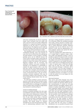 PRACTICE
302 BRITISH DENTAL JOURNAL VOLUME 197 NO. 6 SEPTEMBER 25 2004
soft-tissue swelling (Fig. 4) and an exquisitely
tender tooth. Extrusion from the socket will
often cause the tooth to be mobile. Differential
diagnosis of a suspected periapical swelling is
important in case the cause is a lateral peri-
odontal abscess. The diagnosis can be made by
testing the vitality of the tooth. If it is vital, then
the cause may well be periodontal in origin.
The immediate task is to relieve pressure by
establishing drainage, and in the majority of
cases this can be achieved by first opening up
the pulp chamber, as seen in Figure 5. Initially,
gaining access can be difficult because the
tooth is often extremely tender. Gently grip the
tooth and use a small, round, diamond bur in a
turbine to reduce the trauma of the operation.
Regional analgesia may be necessary, and
inhalation sedation can prove invaluable. If
drainage is not immediate it is permissible to
explore the apical foramen with a very fine
(size 08 or 10) file. The foramen should not be
instrumented or enlarged, and if drainage does
not result the procedure should not be perse-
vered. As discussed in Part 7, the use of ultra-
sonically activated endodontic files may be
particularly helpful in this situation for effec-
tively flushing infected debris from the root
canal system.
If a soft-tissue swelling is present and point-
ing intra-orally, then it may be incised to estab-
lish drainage as well. The presence of a cellulitis
may result in little or no drainage. If a cellulitis is
present, medical advice should be sought before
any treatment is carried out (Fig. 6).
Incision to establish drainage
Incision to establish drainage is the only surgi-
cal endodontic procedure which may be under-
taken when acute inflammation is present. The
principal indication is the presence of a collec-
tion of pus which points from a fluctuant
abscess in the soft tissues. Establishing drainage
to help bring the infection under control is
essential, and should always be obtained
through the root canal and soft tissues in prefer-
ence to administering antibiotics alone. The
soft-tissue swelling should be examined to see
if it is fluctuant. Where the swelling is pointing
intra-orally, copious amounts of surface anal-
gesia should be applied, for example ethyl chlo-
ride or topical lignocaine ointment. Regional
anaesthesia may not be effective due to the
presence of pus, and the administration of a
local analgesic solution may spread the infec-
tion further into the tissues.
Incise the swelling with a Bard–Parker No. 11
or 15 scalpel blade, or aspirate, using a wide-
bore needle and disposable syringe. It may be
possible to aspirate the abscess via the root canal
as well. The advantage of this technique is that
the sample can be sent for bacteriological exam-
ination if required. It is not usually necessary to
insert a drain, but if it is thought necessary then
a piece of quarter-inch or half-inch selvedge
gauze may be used. The same criteria apply
when extra-oral drainage is indicated, and it
may be possible to use the same technique of
aspiration with a wide-bore needle and dispos-
able syringe. However, if an extra-oral incision
is considered necessary, as in Figure 7, it is wise
to refer the patient to an oral surgeon for this
particular procedure.
Root canal treatment
Once access and initial drainage have been
achieved, a rubber dam should be applied to the
tooth to complete the operation. Before any fur-
ther instrumentation is carried out, the pulp
chamber should be thoroughly irrigated with a
solution of sodium hypochlorite to remove as
much superficial organic and inorganic debris
as possible. This in itself may bring considerable
pain relief and will make subsequent instru-
mentation easier. Having debrided the canals to
the best possible extent with frequent changes
of irrigant, the canals should be dried with
paper points and a dry sterile cotton wool pled-
get placed in the pulp chamber to prevent
ingress of the temporary dressing. The access
cavity is then sealed to prevent re-infection of
the canals from the oral cavity. If complete
debridement was not possible the patient must
Fig. 5 Immediate relief is obtained as pus drains feely from an access cavity.
Fig. 4 A pronounced
swelling may be
present adjacent to the
abscessed tooth.
06p299-305.qxd 24/08/2004 11:26 Page 302
 