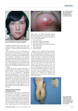 PRACTICE
BRITISH DENTAL JOURNAL VOLUME 197 NO. 6 SEPTEMBER 25 2004 303
be recalled within 48 hours. At this time it will
usually be possible to complete instrumentation
and place a calcium hydroxide dressing in the
canals.
The temptation to leave the tooth open to
drain must be resisted at all costs.10 The micro-
bial flora of the canal will be changed, making
treatment more difficult and lowering the long-
term prognosis. Furthermore, this treatment
contravenes the prime objective of treatment: to
disinfect the root canal. If the clinician does not
have sufficient time to carry out adequate treat-
ment when opening the tooth, good clinical
practice would suggest re-appointing the patient
to the end of the treatment session when time is
available.
Antibiotics are only required when there is
systemic spread of the infection, the patient is
unwell and has a raised temperature. Antibi-
otics are not an alternative to appropriate
cleaning and disinfection of the root canal.11
There is a serious tendency to over prescription
of antibiotics in situations where they are not
indicated. If, however, there is a clinical reason
for their use, amoxycillin is usually the agent of
choice, prescribing 250 mg three times a day
until the infection is under control and root
canal therapy initiated. Metronidazole is a use-
ful alternative where the penicillins are contra-
indicated.
CRACKED TOOTH SYNDROME
(POSTERIOR TEETH)
Crazing of the enamel surface is a common find-
ing on teeth as a consequence of function, but
on occasion it may indicate a cracked tooth. If
the crack runs deep into dentine and is therefore
a fracture, chewing may be painful. Initially, this
may not be of sufficient intensity for the patient
to seek treatment. However, once the fracture
line communicates with the pulp, pulpitis will
ensue. A quiescent period of several months may
follow before any further symptoms develop.
The patient may present with a whole range of
bizarre symptoms, many of which are similar to
those of irreversible pulpitis:
• Pain on chewing.
• Sensitivity to hot and cold fluids.
• Pain which is difficult to localize.
• Pain referred along to the areas served by the
fifth cranial nerve.
• Acute pulpal pain.
• Alveolar abscess.
Diagnosis can be difficult and much depends
on the plane of the fracture line and its site on
the tooth. Radiographs are unlikely to reveal a
fracture unless it runs in a buccolingual plane.
A fibre-optic light is a useful aid as it will often
reveal the position of the fracture. One diag-
nostic test is to ask the patient to bite on a piece
of folded rubber dam. Care must be exercised as
this test may extend the fracture line. The
extent of the fracture line and its site will
decide whether the tooth can be saved or not. If
it is a vertical fracture, involves the root canal
system and extends below the level of the alve-
olar crest, then the prognosis is poor and
extraction is indicated (Fig. 8). However, if the
fracture line is horizontal or diagonal and
superficial to the alveolar crest, then the prog-
nosis may be better.
Fig. 6 A teenage patient who had a large periapical
lesion of a lower incisor is developing a cellulitis.
Fig. 7 External incision
may be required, and
the patient should
preferably be referred
to a general surgeon.
Fig 8 A patient who
complained of classic
‘cracked-cusp’ pain
was found to have such
a deep subgingival cusp
fracture that the tooth
was extracted.
06p299-305.qxd 24/08/2004 11:28 Page 303
 