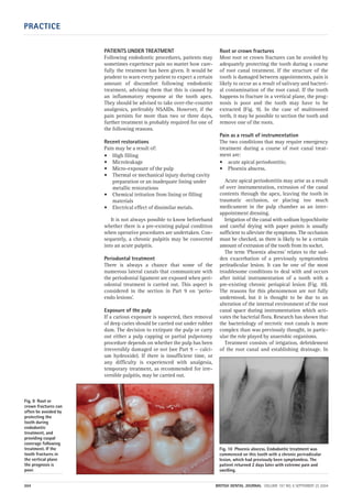 PRACTICE
304 BRITISH DENTAL JOURNAL VOLUME 197 NO. 6 SEPTEMBER 25 2004
PATIENTS UNDER TREATMENT
Following endodontic procedures, patients may
sometimes experience pain no matter how care-
fully the treatment has been given. It would be
prudent to warn every patient to expect a certain
amount of discomfort following endodontic
treatment, advising them that this is caused by
an inflammatory response at the tooth apex.
They should be advised to take over-the-counter
analgesics, preferably NSAIDs. However, if the
pain persists for more than two or three days,
further treatment is probably required for one of
the following reasons.
Recent restorations
Pain may be a result of:
• High filling
• Microleakage
• Micro-exposure of the pulp
• Thermal or mechanical injury during cavity
preparation or an inadequate lining under
metallic restorations
• Chemical irritation from lining or filling
materials
• Electrical effect of dissimilar metals.
It is not always possible to know beforehand
whether there is a pre-existing pulpal condition
when operative procedures are undertaken. Con-
sequently, a chronic pulpitis may be converted
into an acute pulpitis.
Periodontal treatment
There is always a chance that some of the
numerous lateral canals that communicate with
the periodontal ligament are exposed when peri-
odontal treatment is carried out. This aspect is
considered in the section in Part 9 on ‘perio-
endo lesions’.
Exposure of the pulp
If a carious exposure is suspected, then removal
of deep caries should be carried out under rubber
dam. The decision to extirpate the pulp or carry
out either a pulp capping or partial pulpotomy
procedure depends on whether the pulp has been
irreversibly damaged or not (see Part 9 — calci-
um hydroxide). If there is insufficient time, or
any difficulty is experienced with analgesia,
temporary treatment, as recommended for irre-
versible pulpitis, may be carried out.
Root or crown fractures
Most root or crown fractures can be avoided by
adequately protecting the tooth during a course
of root canal treatment. If the structure of the
tooth is damaged between appointments, pain is
likely to occur as a result of salivary and bacteri-
al contamination of the root canal. If the tooth
happens to fracture in a vertical plane, the prog-
nosis is poor and the tooth may have to be
extracted (Fig. 9). In the case of multirooted
teeth, it may be possible to section the tooth and
remove one of the roots.
Pain as a result of instrumentation
The two conditions that may require emergency
treatment during a course of root canal treat-
ment are:
• acute apical periodontitis;
• Phoenix abscess.
Acute apical periodontitis may arise as a result
of over instrumentation, extrusion of the canal
contents through the apex, leaving the tooth in
traumatic occlusion, or placing too much
medicament in the pulp chamber as an inter-
appointment dressing.
Irrigation of the canal with sodium hypochlorite
and careful drying with paper points is usually
sufficient to alleviate the symptoms. The occlusion
must be checked, as there is likely to be a certain
amount of extrusion of the tooth from its socket.
The term ‘Phoenix abscess’ relates to the sud-
den exacerbation of a previously symptomless
periradicular lesion. It can be one of the most
troublesome conditions to deal with and occurs
after initial instrumentation of a tooth with a
pre-existing chronic periapical lesion (Fig. 10).
The reasons for this phenomenon are not fully
understood, but it is thought to be due to an
alteration of the internal environment of the root
canal space during instrumentation which acti-
vates the bacterial flora. Research has shown that
the bacteriology of necrotic root canals is more
complex than was previously thought, in partic-
ular the role played by anaerobic organisms.
Treatment consists of irrigation, debridement
of the root canal and establishing drainage. In
Fig. 9 Root or
crown fractures can
often be avoided by
protecting the
tooth during
endodontic
treatment, and
providing cuspal
coverage following
treatment. If the
tooth fractures in
the vertical plane
the prognosis is
poor.
Fig. 10 Phoenix abscess. Endodontic treatment was
commenced on this tooth with a chronic periradicular
lesion, which had previously been symptomless. The
patient returned 2 days later with extreme pain and
swelling.
06p299-305.qxd 24/08/2004 11:28 Page 304
 