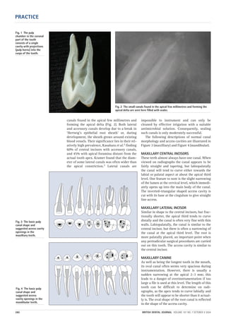 PRACTICE
380 BRITISH DENTAL JOURNAL VOLUME 197 NO. 7 OCTOBER 9 2004
canals found in the apical few millimetres and
forming the apical delta (Fig. 2). Both lateral
and accessory canals develop due to a break in
‘Hertwig’s epithelial root sheath’ or, during
development, the sheath grows around existing
blood vessels. Their significance lies in their rel-
atively high prevalence, Kasahara et al.2 finding
60% of central incisors with accessory canals,
and 45% with apical foramina distant from the
actual tooth apex. Kramer found that the diam-
eter of some lateral canals was often wider than
the apical constriction.3 Lateral canals are
impossible to instrument and can only be
cleaned by effective irrigation with a suitable
antimicrobial solution. Consequently, sealing
such canals is only moderately successful.
The following descriptions of normal canal
morphology and access cavities are illustrated in
Figure 3 (maxilliary) and Figure 4 (mandibular).
MAXILLARY CENTRAL INCISORS
These teeth almost always have one canal. When
viewed on radiographs the canal appears to be
fairly straight and tapering, but labiopalatally
the canal will tend to curve either towards the
labial or palatal aspect at about the apical third
level. One feature to note is the slight narrowing
of the lumen at the cervical level, which immedi-
ately opens up into the main body of the canal.
The inverted-triangular shaped access cavity is
cut with its base at the cingulum to give straight
line access.
MAXILLARY LATERAL INCISOR
Similar in shape to the central incisors, but frac-
tionally shorter, the apical third tends to curve
distally and the canal is often very fine with thin
walls. Labiopalatally, the canal is similar to the
central incisor, but there is often a narrowing of
the canal at the apical third level. The root is
more palatally placed, an important point when
any periradicular surgical procedures are carried
out on this tooth. The access cavity is similar to
the central incisor.
MAXILLARY CANINE
As well as being the longest tooth in the mouth,
its oval canal often seems very spacious during
instrumentation. However, there is usually a
sudden narrowing at the apical 2–3 mm; this
leads to a danger of overinstrumentation if too
large a file is used at this level. The length of this
tooth can be difficult to determine on radi-
ographs, as the apex tends to curve labially and
the tooth will appear to be shorter than it actual-
ly is. The oval shape of the root canal is reflected
in the shape of the access cavity.
Fig. 3 The basic pulp
canal shape and
suggested access cavity
openings in the
maxilliary teeth.
Fig. 4 The basic pulp
canal shape and
suggested access
cavity openings in the
mandibular teeth.
Fig. 1 The pulp
chamber in the coronal
part of the tooth
consists of a single
cavity with projections
(pulp horns) into the
cusps of the tooth.
Fig. 2 The small canals found in the apical few millimetres and forming the
apical delta are seen here filled with sealer.
07p379-383.qxd 07/09/2004 12:32 Page 380
 