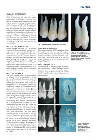 PRACTICE
BRITISH DENTAL JOURNAL VOLUME 197 NO. 7 OCTOBER 9 2004 381
MAXILLARY FIRST PREMOLAR
Typically, this tooth has two roots with two
canals. In many ways this is the most difficult
tooth to treat, as it can have a complex canal
system. Variations range from one to three roots,
(Fig. 5), but there are nearly always at least two
canals present, even if they exit through a com-
mon apical foramen. The roots of these teeth are
very delicate and at the apical third they may
curve quite sharply buccally, palatally, mesially
or distally, so instrumentation needs to be car-
ried out with great care (Fig. 6). In a small per-
centage of cases the buccal root may subdivide
into two canals in the apical third, as shown in
Figure 7. An oval access cavity is cut between
the cusp tips, being wider buccopalatally than
mesiodistally.
MAXILLARY SECOND PREMOLAR
In 40% of cases, this tooth, which is similar in
length to the first premolar, has one root with a
single canal. Two canals may be found in about
58% of cases.4 The configuration of the two
canals may vary with two separate canals and
two exits, two canals and one common exit, one
canal dividing and having two exits. In one
study,5 it was found that 59% of maxillary sec-
ond premolars had accessory canals. As with the
first maxillary premolar, the apical third of the
root may curve quite considerably, mainly to the
distal, sometimes buccally. The access cavity is
similar to the first premolar.
MAXILLARY FIRST MOLAR
This tooth has three roots. The palatal root is
the longest, with an average length of 22 mm;
the mesiobuccal and distobuccal roots are
slightly shorter, at 21 mm average length. The
percentage of mesiobuccal roots having two
canals reported in the literature has increased
steadily as research techniques have devel-
oped. In vitro studies have usually reported a
higher incidence than in vivo studies. Stropko,
reporting an extensive in vivo study,6 found
second canals in 73% of cases before the use
of an operating microscope, but 93% follow-
ing its use. The canals of the mesiobuccal root
are often very fine and difficult to negotiate;
consequently, more errors in instrumentation
occur in this tooth than in almost any other.
Anastomosis between these two canals may
take the form of narrow canals or wide fins,
both almost impossible to instrument. The
curvature of the roots can be difficult to visu-
alize from radiographs, and the second
mesiobuccal canal is nearly always superim-
posed on the primary mesiobuccal canal. The
palatal root has a tendency to curve towards
the buccal and the apparent length on a radi-
ograph will be shorter than its actual length.
The access cavity represents the shape of the
pulp chamber, enlarged slightly, and flared up
on to the mesiobuccal aspect of the occlusal
surface to accommodate the angle of instru-
ment approach when working at the back of
the mouth.
MAXILLARY SECOND MOLAR
This tooth is similar to the first maxillary molar,
but slightly smaller and shorter, with straighter
roots and thinner walls. Usually there are only
three canals and the roots are sometimes fused.
The access cavity is the same as for the first
molar, modified further to accommodate the
angle of approach.
MAXILLARY THIRD MOLAR
The morphology of this tooth can vary consider-
ably, ranging from a copy of the first or second
maxillary molar to a canal system that is quite
complex. They are best explored with a wide
access cavity and direct vision of the individual
canal anatomy.
Fig. 5 Examples of upper premolars with three roots.
Fig. 6 The roots of upper first
premolars are very delicate and may
curve quite sharply buccally,
palatally, mesially or distally, so
instrumentation needs to be carried
out with great care.
Fig. 7 Cross-sections
taken at different
levels in a maxillary
first premolar showing
the division of the
buccal canal.
07p379-383.qxd 07/09/2004 12:33 Page 381
 
