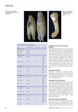 PRACTICE
382 BRITISH DENTAL JOURNAL VOLUME 197 NO. 7 OCTOBER 9 2004
MANDIBULAR CENTRAL AND LATERAL
INCISORS
The morphology of these two teeth is very simi-
lar. The central incisor has an average length of
20.5 mm and the lateral is a little longer with
an average length of 21 mm. Over 40% of these
teeth have two canals, but only just over 1%
have two separate foramina. Careful reading of
the pre-operative radiograph may show a
change in the radiodensity of the root canal,
indicating division into two separate canals,
and a correctly designed access cavity will
facilitate checking for a second canal. This is
oval in shape, commencing above the cingu-
lum and almost notching the lingual incisal
edge.
MANDIBULAR CANINE
This tooth is similar to its opposite number,
although not as long. On rare occasions, two
roots may exist and this can cause difficulty
with instrumentation (Fig. 8). An oval access
cavity is again indicated.
MANDIBULAR FIRST PREMOLAR
The canal configuration of this tooth can be
quite complex. Vertucci7 has shown that the sin-
gle canal normally found may divide into two
canals and two apical foramina in 25% of cases.
It is the way in which the second canal branches
that can cause difficulty with instrumentation.
Occasionally, the canal terminates with an
extensive delta, making obturation of the acces-
sory canals even more challenging. As in the
upper premolars, the access cavity is oval
between the cusp tips.
MANDIBULAR SECOND PREMOLAR
This tooth is similar to the first premolar, except
that the incidence of a second canal is very
much lower. One study stated this to be 12%.7
Another study revealed that only 2.5% had two
Table 1 Average root canal configurations
Tooth Average Length No. of roots No. of canals
Maxillary anteriors
Central incisor 22.5 mm 1 1
Lateral incisor 22.0 mm 1 1
Canine 26.5 mm 1 1
Maxillary premolar
First premolar 20.6 mm 2-3 1 (6.%)
2 (95%)
3 (1%)
Second premolar 21.5 mm 1-3 1 (75%)
2 (24%)
3 (1%)
Maxillary molars
First molar 20.8 mm 3 4 (93%)
3 (7%)
Second molar 20.0 mm 3 4 (37%)
3 (63%)
Third molar 17.0 mm 1-3
Mandibular anteriors
Central incisor 20.7 mm 1 1 (58%)
2 (42%)
Lateral incisor 20.7 mm 1-2 1 (58%)
2 (42%)
Canine 25.6 mm 1 1 (94%)
2(6%)
Mandibular premolars
First premolar 21.6 mm 1 1 (73%)
2 (27%)
Second premolar 22.3 mm 1 1 (85%)
2 (15%)
Mandibular molars
First molar 21.0 mm 2-3 3 (67%)
4 (33%)
Second molar 19.8 mm 2 2 (13%)
3 (79%)
4 (8%)
Third molar 18.5 mm 1-2
Fig. 8 Lower canines may
occasionally be found with two
separate roots.
Fig. 9 A lower second
premolar with a severe
distal curve at the
apex.
07p379-383.qxd 07/09/2004 12:34 Page 382
 