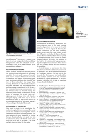 PRACTICE
BRITISH DENTAL JOURNAL VOLUME 197 NO. 7 OCTOBER 9 2004 383
apical foramina.8 Consequently, it is a much eas-
ier tooth to treat compared with the mandibular
first premolar, unless the radiograph reveals a
sharp distal curve at the apex as shown in the
extracted tooth at Figure 9.
MANDIBULAR FIRST MOLAR
This is often the most heavily restored tooth in
the adult dentition and seems to be a frequent
candidate for root canal treatment. Generally
there are two roots and three canals: two canals
in the mesial root and one large oval canal dis-
tally. According to Skidmore and Bjorndal,9 one
third of these molars have four canals. Occa-
sionally, three roots are to be found: usually two
distal and one mesial (Fig. 10), rarely one distal
and two mesial. Anastomoses occur between
the canals and accessory communication with
the furcation area is a frequent finding. The
mesiobuccal canal tends to exhibit the greatest
degree of curvature. The access cavity once
again represents the shape of the pulp chamber,
enlarged slightly, and flared up on to the
mesiobuccal aspect of the occlusal surface to
accommodate the angle of instrument approach
when working at the back of the mouth.
MANDIBULAR SECOND MOLAR
This tooth is similar to the mandibular first
molar, although a little more compact. The mesial
canals tend to lie much closer together, and the
incidence of two canals distally is much less. This
tooth seems to be more susceptible to vertical
fracture. Occasionally, the root canals may join
in a buccal fin giving a ‘C-shaped’ canal, which
may lead all the way to the apex.10 The access
cavity is similar to that of the first molar.
MANDIBULAR THIRD MOLAR
Together with the maxillary third molar, this
tooth displays some of the most irregular
canal configurations to be found in the adult
dentition, as seen in Figure 11. However, the
mesial inclination of the tooth generally
makes access easier. The canal orifices are not
too difficult to locate, but the degree of curva-
ture of the apical half of the root canal system
is often pronounced. Added to this, the apex is
frequently poorly developed and lies close to
the inferior alveolar canal. A large access cav-
ity allowing direct visualization of the floor of
the pulp chamber enables the canal orifices to
be identified.
It should always be remembered that whilst
the above descriptions are the norm, occasional-
ly other teeth may be encountered with unusual
or even bizarre anatomy. This may only be dis-
covered after the treatment has failed and the
tooth has been extracted. Clues may sometimes
be found by careful examination of the radi-
ographs, especially with the use of magnifica-
tion, as described in Part 5.
1. Hess W, Zurcher E. The anatomy of the root canals of
the teeth of the permanent dentition and the anatomy
of the root canals of the deciduous dentition and the
first permanent molars. London: Basle, Sons and
Danielson, 1925.
2. Kasahara E,Yasuda E, Yamamoto A, Anzai M. Root
canal systems of the maxillary central incisor. J Endod
1990; 16: 158–161.
3. Kramer I R. The vascular architecture of the human
dental pulp. Arch Oral Biol 1960; 2: 177–189.
4. Bellizi R, Hartwell G. Radiographic evaluation of root
canal anatomy of in vivo endodontically treated
maxillary premolars. J Endod 1985; 11: 37–39.
5. Vertucci F J, Seeling A, Gillis R. Root canal
morphology of the human maxillary second premolar.
Oral Surg 1974; 38: 456-464.
6. Stropko J J. Canal morphology of maxillary molars:
clinical observations of canal configurations. J Endod
1999; 25: 446–450.
7. Zillich R, Dowson J. Root canal morphology of the
mandibular first and second premolars. Oral Surg
1973; 36: 738–744.
8. Vertucci F J. Root canal morphology of
mandibular premolars. J Am Dent Assoc 1978;
97: 47–50.
9. Skidmore A E, Bjorndal A M. Root canal morphology
of the human mandibular first molar. Oral Surg 1971;
32: 778–784.
10. Melton D C, Krall K V, Fuller M W. Anatomical and
histological features of C-shaped canals in mandibular
second molars. J Endod 1991; 17: 384–388.
Fig. 11 The
developmental
anatomy of lower third
molars may be quite
bizarre.
Fig. 10 Lower first molars may occasionally be found
with two separate distal roots.
07p379-383.qxd 07/09/2004 12:36 Page 383
 