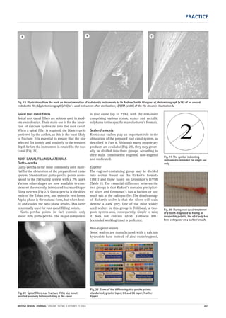 PRACTICE
BRITISH DENTAL JOURNAL VOLUME 197 NO. 8 OCTOBER 23 2004 461
Spiral root canal fillers
Spiral root canal fillers are seldom used in mod-
ern endodontics. Their main use is for the inser-
tion of calcium hydroxide into the root canal.
When a spiral filler is required, the blade type is
preferred by the author, as this is the least likely
to fracture. It is essential to ensure that the size
selected fits loosely and passively to the required
depth before the instrument is rotated in the root
canal (Fig. 21).
ROOT CANAL FILLING MATERIALS
Gutta-percha
Gutta-percha is the most commonly used mate-
rial for the obturation of the prepared root canal
system. Standardized gutta-percha points corre-
spond to the ISO sizing system with a 2% taper.
Various other shapes are now available to com-
plement the recently introduced increased taper
filing systems (Fig 22). Gutta-percha is the dried
resin of the Taban tree, and exists in two forms.
Alpha phase is the natural form, but when heat-
ed and cooled the beta-phase results. This latter
is normally used for root canal filling points.
Gutta-percha points in fact contain only
about 20% gutta-percha. The major component
is zinc oxide (up to 75%), with the remainder
comprising various resins, waxes and metallic
sulphates to the specific manufacturer’s formula.
Sealers/cements
Root canal sealers play an important role in the
obturation of the prepared root canal system, as
described in Part 8. Although many proprietary
products are available (Fig. 23), they may gener-
ally be divided into three groups, according to
their main constituents: eugenol, non-eugenol
and medicated.
Eugenol
The eugenol-containing group may be divided
into sealers based on the Rickert’s formula
(1931) and those based on Grossman’s (1958)
(Table 1). The essential difference between the
two groups is that Rickert’s contains precipitat-
ed silver and Grossman’s has a barium or bis-
muth salt as the radiopacifier. The disadvantage
of Rickert’s sealer is that the silver will stain
dentine a dark grey. One of the most widely
used sealers in this group is Tubliseal, a two-
paste system and, consequently, simple to mix;
it does not contain silver. Tubliseal EWT
(extended working time) is preferred.
Non-eugenol sealers
Some sealers are manufactured with a calcium
hydroxide base instead of zinc oxide/eugenol,
Fig. 18 Illustrations from the work on decontamination of endodontic instruments by Dr Andrew Smith, Glasgow: a) photomicrograph (x16) of an unused
endodontic file; b) photomicrograph (x16) of a used instrument after sterilization; c) SEM (x500) of the file shown in illustration b.
a b c
Fig. 20 During root canal treatment
of a tooth diagnosed as having an
irreversible pulpitis, the vital pulp has
been extirpated on a barbed broach.
Fig. 21 Spiral fillers may fracture if the size is not
verified passively before rotating in the canal.
Fig. 19 The symbol indicating
instruments intended for single use
only.
Fig. 22 Some of the different gutta-percha points:
standarized; greater taper; 04 and 06 taper; feather
tipped.
08p455-464.qxd 22/09/2004 10:29 Page 461
 