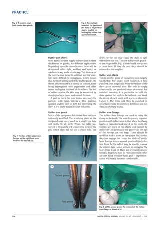 Rubber dam sheets
Most manufacturers supply rubber dam in three
thicknesses or grades, for different applications.
Depending upon the manufacturer, these will be
designated either light, medium and heavy, or
medium, heavy and extra-heavy. The thinnest of
the three is more prone to splitting, and the heav-
iest more difficult to manipulate, which means
that the most widely used is the middle grade. The
sheets are presented in a variety of colours, some
being impregnated with peppermint and other
scents to disguise the smell of the rubber. The feel
of rubber against the skin may be countered by
simply placing a gauze underneath the dam.
A pack of latex free dam is also necessary for
patients with latex allergies. This material
appears slightly stiff at first but stretching the
sheet a few times makes it easier to handle.
Rubber dam punch
Much of the equipment for rubber dam has been
rationally modified. The revolving plate on the
old punch was rarely used, as a single size hole
will really fit all teeth. When the table was
moved it frequently led to eccentric wear of the
pin, which then did not cut a clean hole. The
defect in the cut may cause the dam to split
when stretched out. The new rubber dam punch-
es are single table (Fig. 2) and should always cut
a clean hole. If they do not, they should be
returned to the supplier.
Rubber dam stamp
This is another piece of equipment now largely
superseded. For single tooth isolation, a hole
punched 2 cm diagonally from the middle of the
sheet gives universal dam. The hole is simply
orientated to the quadrant under treatment. For
multiple isolation, it is preferable to hold the
dam against the teeth to be isolated, and mark
the centre of each tooth with a pen, as shown in
Figure 3. The holes will then be punched in
accordance with the patient’s dentition and not
with an arbitrary stamp.
Rubber dam forceps
The rubber dam forceps are used to carry the
clamp to the tooth. The most frequently reported
problem with rubber dam is that when the clamp
has been expanded and placed on the tooth, the
forceps are stuck in the clamp and cannot be
removed! This is because the grooves in the tips
of the forceps are too deep. These should be
modified with a stone or sandpaper disc so that
they just engage the clamp, but slide off easily.
Most forceps have a second groove slightly dis-
tant from the tip, which may be used to remove
the rubber dam clamp without re-engaging the
holes (Figs 4 and 5). There are several designs of
forceps, and they may be employed with either
an over-hand or under-hand grip — experimen-
tation will reveal the most comfortable.
Fig. 3 For multiple
isolation, the position of
the holes to be punched
may be marked by
holding the rubber dam
against the teeth.
PRACTICE
528 BRITISH DENTAL JOURNAL VOLUME 197 NO. 9 NOVEMBER 13 2004
Fig. 2 A modern single
table rubber dam punch.
Fig. 5 a) The second groove for removal of the rubber
dam clamp, as shown in b).
Fig. 4 The tips of the rubber dam
forceps on the right have been
modified for ease of use.
a b
Second groove
First groove
09p527-534.qxd 27/10/2004 09:25 Page 528
 
