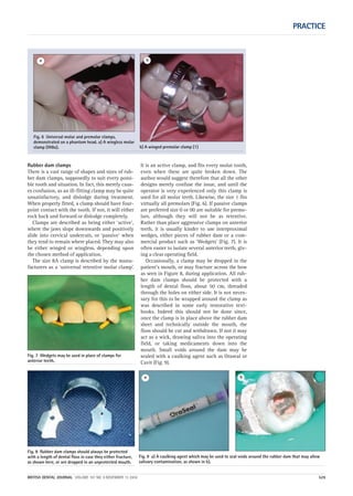 Rubber dam clamps
There is a vast range of shapes and sizes of rub-
ber dam clamps, supposedly to suit every possi-
ble tooth and situation. In fact, this merely caus-
es confusion, as an ill-fitting clamp may be quite
unsatisfactory, and dislodge during treatment.
When properly fitted, a clamp should have four-
point contact with the tooth. If not, it will either
rock back and forward or dislodge completely.
Clamps are described as being either ‘active’,
where the jaws slope downwards and positively
slide into cervical undercuts, or ‘passive’ when
they tend to remain where placed. They may also
be either winged or wingless, depending upon
the chosen method of application.
The size 8A clamp is described by the manu-
facturers as a ‘universal retentive molar clamp’.
It is an active clamp, and fits every molar tooth,
even when these are quite broken down. The
author would suggest therefore that all the other
designs merely confuse the issue, and until the
operator is very experienced only this clamp is
used for all molar teeth. Likewise, the size 1 fits
virtually all premolars (Fig. 6). If passive clamps
are preferred size 0 or 00 are suitable for premo-
lars, although they will not be as retentive.
Rather than place aggressive clamps on anterior
teeth, it is usually kinder to use interproximal
wedges, either pieces of rubber dam or a com-
mercial product such as ‘Wedgets’ (Fig. 7). It is
often easier to isolate several anterior teeth, giv-
ing a clear operating field.
Occasionally, a clamp may be dropped in the
patient’s mouth, or may fracture across the bow
as seen in Figure 8, during application. All rub-
ber dam clamps should be protected with a
length of dental floss, about 50 cm, threaded
through the holes on either side. It is not neces-
sary for this to be wrapped around the clamp as
was described in some early restorative text-
books. Indeed this should not be done since,
once the clamp is in place above the rubber dam
sheet and technically outside the mouth, the
floss should be cut and withdrawn. If not it may
act as a wick, drawing saliva into the operating
field, or taking medicaments down into the
mouth. Small voids around the dam may be
sealed with a caulking agent such as Oraseal or
Cavit (Fig. 9).
Fig. 9 a) A caulking agent which may be used to seal voids around the rubber dam that may allow
salivary contamination, as shown in b).
PRACTICE
BRITISH DENTAL JOURNAL VOLUME 197 NO. 9 NOVEMBER 13 2004 529
Fig. 7 Wedgets may be used in place of clamps for
anterior teeth.
Fig. 6 Universal molar and premolar clamps,
demonstrated on a phantom head. a) A wingless molar
clamp (W8a). b) A winged premolar clamp (1)
a b
Fig. 8 Rubber dam clamps should always be protected
with a length of dental floss in case they either fracture,
as shown here, or are dropped in an unprotected mouth.
a b
09p527-534.qxd 27/10/2004 09:26 Page 529
 