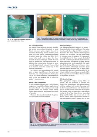 The rubber dam frame
The old Ash frame, with its ‘butterfly’ retainers,
has largely been replaced by plastic or metal
frames with sharp points or pins. It should be
noted that the majority of these retentive points
slope backwards, and the frames are designed to
be placed under the rubber dam (Fig. 10). It
seems to be much easier to place the frame
beneath the dam and simply stretch the sheet
over the points than the other way round. In
addition, the tension in the sheet can be better
controlled, particularly relevant when working
in a situation where the clamp may be less
retentive than normal.
For comfort, most patients appreciate a small
piece of gauze placed between the rubber and
their skin, and some practitioners place a prop
(an old McKesson anaesthetic type) between the
teeth on the non-working side to relieve the
patient’s muscle tension.
APPLICATION TECHNIQUES
A well-trained dental nurse and a well organised
surgery, are essential for efficient application of
the rubber dam. If a tray is prepared with ready
punched sheets, and sterilised clamps already
flossed, application can be performed in a matter
of seconds.
There are three standard methods of applica-
tion, described and illustrated here.
Winged technique
The appropriate winged clamp (8A for molars, 1
for premolars) is selected and flossed. The rubber
dam is punched and aligned with the quadrant to
be treated. The clamp is held in the forceps and
retained with the ratchet. The hole in the rubber
is stretched across the wings of the clamp, posi-
tioning the bow of the clamp towards the back of
the arch. All this may be done by the dental nurse
while the dentist is otherwise occupied, perhaps
administering the local anaesthetic. The nurse
then holds the top of the sheet to improve vision
for the operator, who simply places the clamp
onto the tooth to be treated (Fig. 11). A flat plastic
instrument is then used to push the rubber off the
wings, and the frame and gauze are applied. The
floss may then be removed and the seal verified
or adjusted as necessary.
Wingless technique
The appropriate wingless clamp (W8A for
molars, W1 for premolars) is selected and
flossed. The rubber dam is punched and aligned
with the quadrant to be treated. The clamp, held
in the forceps and retained with the ratchet, is
placed securely on the tooth. One advantage of
this method is that the opportunity now exists to
verify the fit of the clamp before proceeding
(Fig. 12). The rubber dam is now held in both
hands, and the index fingers used to stretch out
the punched hole, which is slipped over the bow
PRACTICE
530 BRITISH DENTAL JOURNAL VOLUME 197 NO. 9 NOVEMBER 13 2004
Fig. 10 The rubber dam frame may be easier to
place beneath the rubber sheet.
Fig. 11 The winged technique. The hole in the rubber sheet has been stretched over the wings of the
clamp a), which is then fitted to the tooth b). The rubber is pushed off the wings, and the seal verified.
a b
Fig. 12 The wingless technique. a) The flossed clamp has been placed on the tooth, and b) the rubber is stretched
over the bow and pulled forward around the clamp.
a b
09p527-534.qxd 27/10/2004 09:27 Page 530
 