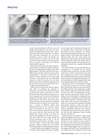 PRACTICE
182 BRITISH DENTAL JOURNAL VOLUME 197 NO. 4 AUGUST 28 2004
canals, thus permitting the effective access of
antimicrobial irrigants to the entire root canal
system, including lateral canals, fins, anasta-
moses and other canal aberrations. It is imper-
ative that these instruments are not seen as
providing a route to quick and speedy root
canal treatment. To achieve success the time
saved by the rapid opening of the canal system
must be spent in thorough and effective
antimicrobial irrigation.
Research has also shown that when an infect-
ed root canal is accessed, the number of different
species of microorganisms is small, rarely above
single figures.3 Treatment will become far more
difficult and extended, and success may well be
compromised, if this flora is altered by the
ingress of saliva. Isolation of the tooth under
treatment is essential not only for medicolegal
reasons to protect the airway, but, far more
importantly, to prevent further contamination of
the root canal system and to permit the use of
strong intracanal medicaments.
Other areas of research have had the signifi-
cant effect of changing the approach to
endodontic treatment. The hollow tube theory
put forward by Rickert and Dixon in 19314
postulated that tissue fluids entering the root
canal stagnated and formed toxic breakdown
products which then passed out into the peri-
apical tissues. This theory, that dead spaces
within the body must be obturated, originally
formed the basis for filling root canals. How-
ever, a variety of different studies have
demonstrated that, on the contrary, hollow
tubes are tolerated by the body. As a result
there are currently two indications for filling a
root canal, once the canal system has been
shaped and cleaned. Firstly, to prevent the
entry of microorganisms to the root canal sys-
tem from either the oral cavity, should the
coronal restoration leak or fail, or via the
bloodstream (anachoresis). Secondly, to pre-
vent the ingress of tissue fluid which would
provide a culture medium for any bacteria
remaining within the tooth following treatment.
A report by Klevant and Eggink5 is particular-
ly relevant. They shaped and cleaned a number
of root canals, but the experimental group were
not obturated. They ensured that an effective,
well-sealed, coronal restoration was placed.
They found that healing occurred in every case.
Figure 2 shows a lower molar with a large peri-
radicular lesion. The root canal system was
shaped and cleaned, and an intervisit dressing of
calcium hydroxide placed. The patient did not
return for further treatment for 6 months, when a
radiograph revealed that complete healing had
taken place.
Of course, this does not mean that obturation is
unimportant. It is essential for the reasons
described earlier. It does prove, however, the old
cliché that it is what is removed from the canal
that is important, not what is put in. Similarly,
Ray and Trope6 found that root-treated teeth with
a poor obturation on radiograph but a good coro-
nal restoration had a better prognosis than teeth
with a good obturation but a poor restoration.
The majority of root canal sealers are soluble
and their only function is to fill the minute
spaces between the wall of the root canal and the
root filling material. Their importance, judged
by the number of products advertised in the den-
tal press, has been over-emphasized. Despite
much research, gutta-percha remains the root
filling of choice, although it is recognized that a
biologically inert, insoluble and injectable paste
may be better suited for obturation of the root
canal. Most of the new root canal filling tech-
niques are concerned with methods of heating
gutta-percha, making it softer and easier to
adapt to the irregular shape of the canal wall. It
must be emphasized, however, that, whatever
the obturation system used, if the root canal sys-
tem has not been adequately cleaned healing
may not occur (Fig. 3).
Finally, lesions of endodontic origin which
appear radiographically as areas of radiolucency
around the apices or lateral aspects of the roots
of teeth are, in the majority of cases, sterile.7,8
The lesions are the result of toxins produced by
microorganisms lying within the root canal sys-
tem. This finding suggests that the removal of
microorganisms from the root canal followed by
root filling is the first treatment of choice, and
Fig. 2 (a) The pre-operative radiograph of tooth LR6 (46) shows a large
radiolucent area associated with the root apex and the furcation area. Root
canal treatment was commenced. (b) A radiograph 6 months later when
the patient finally returned to continue treatment shows evidence of bony
repair with a return to a normal periodontal ligament space around the
apex and in the furcation.
a b
04p181-183.qxd 26/07/2004 15:11 Page 182
 