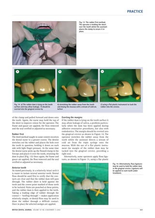 PRACTICE
BRITISH DENTAL JOURNAL VOLUME 197 NO. 9 NOVEMBER 13 2004 531
of the clamp and pulled forward and down onto
the tooth. Again, the nurse may hold the top of
the sheet to improve vision for the operator. The
frame and gauze are applied, the floss removed
and the seal verified or adjusted as necessary.
Rubber first
The third method taught in some centres involves
the dental nurse to a greater extent. The dentist
stretches out the rubber and places the hole over
the tooth in question, holding it down on each
side with light finger pressure. At the same time
the dental nurse picks up the flossed clamp in the
forceps and places it over the tooth, retaining the
dam in place (Fig. 13). Once again, the frame and
gauze are applied, the floss removed and the seal
verified or adjusted as necessary.
Anterior teeth
As stated previously, in a relatively intact arch it
is easier to isolate several anterior teeth. Dental
floss should be used first to verify that the con-
tacts are clear and that the rubber dam will pass
through. The rubber sheet is held against the
teeth and the centre point marked of those teeth
to be isolated. Holes are punched at these points,
and the rubber dam is then applied to the teeth.
Taking a leading edge of rubber through the
contact — ‘knifing through’ — makes application
relatively simple, or dental floss may be used to
draw the rubber through a difficult contact.
Once in place the selected wedges are applied.
Everting the margins
If the rubber dam is lying on the tooth surface it
may allow leakage of saliva, a problem particu-
larly when the dam has been applied during
adhesive restorative procedures, but also with
endodontics. The margin should be everted into
the gingival crevice as shown in Figure 14. The
operator stretches the rubber away from the
tooth whilst the assistant directs a stream of
cold air from the triple syringe onto the
mucosa. With the use of a flat plastic instru-
ment the margin of the rubber dam may be
tucked into the gingival crevice, providing a
tight seal.
Alternatively, some operators apply floss liga-
tures, as shown in Figure 15, using a flat plastic
Fig. 13 The rubber first method.
The operator is holding the sheet
over the tooth whilst the assistant
places the clamp to secure it in
place.
Fig. 14 a) The rubber dam is lying on the tooth
surface and may allow leakage. It should be
everted into the gingival crevice by
b) stretching the rubber away from the tooth
and drying the mucosa with a stream of cold air,
before
c) using a flat plastic instrument to tuck the
rubber into the crevice.
a b c
Fig. 15 Alternatively, floss ligatures
may be used to hold the rubber dam
in the gingival crevice. Ligatures will
be applied to each tooth under
treatment.
09p527-534.qxd 27/10/2004 09:28 Page 531
 