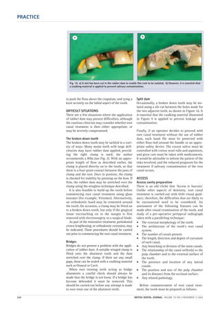 PRACTICE
532 BRITISH DENTAL JOURNAL VOLUME 197 NO. 9 NOVEMBER 13 2004
to push the floss above the cingulum, and tying a
knot securely on the labial aspect of the tooth.
DIFFICULT SITUATIONS
There are a few situations where the application
of rubber dam may present difficulties, although
the cautious clinician may consider whether root
canal treatment is then either appropriate, or
may be severely compromised.
The broken down tooth
The broken down tooth may be tackled in a vari-
ety of ways. Many molar teeth with large defi-
ciencies may have rubber dam applied, provid-
ing the right clamp is used; the author
recommends a W8a (see Fig. 2). With an appro-
priate length of floss as described earlier, the
clamp is placed directly on to the tooth, so that
there is a four-point contact between the jaws of
clamp and the root. Once in position, the clamp
is checked for stability by pressing on the bow. If
firm, the rubber dam may be stretched over the
clamp using the wingless technique described.
It is also feasible to build up the tooth before
commencing root canal treatment using glass
ionomer (for example, Vitremer). Alternatively,
an orthodontic band may be cemented around
the tooth. On occasion, a clamp may be fitted on
to a broken down tooth, but only if the gingival
tissue encroaching on to the margin is first
removed with electrosurgery or a surgical blade.
As part of the restorative treatment, periodontal
crown lengthening, or orthodontic extrusion, may
be indicated. These procedures should be carried
out prior to commencing the root canal treatment.
Bridges
Bridges do not present a problem with the appli-
cation of rubber dam. A suitable winged clamp is
fitted onto the abutment tooth and the dam
stretched over the clamp. If there are any small
gaps, these can be sealed with a caulking material
such as Oraseal or Cavit.
When root treating teeth acting as bridge
abutments a careful check should always be
made that the bridge is not loose. If a bridge has
become debonded it must be removed. This
should be carried out before any attempt is made
to root-treat one of the abutment teeth.
Split dam
Occasionally, a broken down tooth may be iso-
lated using a slit cut between the holes made for
the two adjacent teeth, as shown in Figure 16. It
is essential that the caulking material illustrated
in Figure 9 is applied to prevent leakage and
contamination.
Finally, if an operator decides to proceed with
root canal treatment without the use of rubber
dam, each hand file must be protected with
either floss tied around the handle or an appro-
priate safety device. The excess saliva must be
controlled with cotton wool rolls and aspiration,
and great care must be taken with medicaments.
It would be advisable to inform the patient of the
risks involved, and the reduced prognosis for the
treatment if salivary contamination of the root
canal occurs.
ACCESS
Access cavity preparation
There is an old cliché that ‘Access is Success’.
Unlike other aspects of dentistry, root canal
treatment is carried out with little visual guid-
ance; therefore, the difficulties that are likely to
be encountered need to be considered. An
assessment of the following features can be
made after visual examination of the tooth, and
study of a pre-operative periapical radiograph
taken with a paralleling technique:
• The external morphology of the tooth.
• The architecture of the tooth’s root canal
system.
• The number of canals present.
• The length, direction and degree of curvature
of each canal.
• Any branching or division of the main canals.
• The relationship of the canal orifice(s) to the
pulp chamber and to the external surface of
the tooth.
• The presence and location of any lateral
canals.
• The position and size of the pulp chamber
and its distance from the occlusal surface.
• Any related pathology.
Before commencement of root canal treat-
ment, the tooth must be prepared as follows:
Fig. 16 a) A slot has been cut in the rubber dam to enable this root to be isolated. b) However, it is essential that
a caulking material is applied to prevent salivary contamination.
a b
09p527-534.qxd 27/10/2004 09:29 Page 532
 
