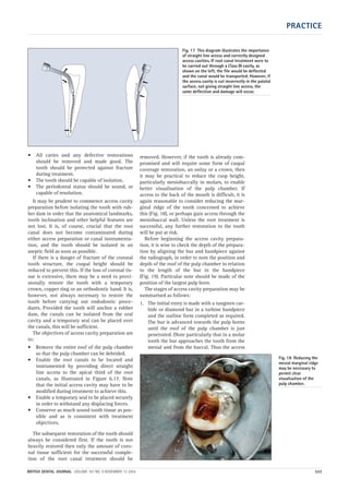PRACTICE
BRITISH DENTAL JOURNAL VOLUME 197 NO. 9 NOVEMBER 13 2004 533
Fig. 18 Reducing the
mesial marginal ridge
may be necessary to
permit clear
visualisation of the
pulp chamber.
• All caries and any defective restorations
should be removed and made good. The
tooth should be protected against fracture
during treatment.
• The tooth should be capable of isolation.
• The periodontal status should be sound, or
capable of resolution.
It may be prudent to commence access cavity
preparation before isolating the tooth with rub-
ber dam in order that the anatomical landmarks,
tooth inclination and other helpful features are
not lost. It is, of course, crucial that the root
canal does not become contaminated during
either access preparation or canal instrumenta-
tion, and the tooth should be isolated in an
aseptic field as soon as possible.
If there is a danger of fracture of the coronal
tooth structure, the cuspal height should be
reduced to prevent this. If the loss of coronal tis-
sue is extensive, there may be a need to provi-
sionally restore the tooth with a temporary
crown, copper ring or an orthodontic band. It is,
however, not always necessary to restore the
tooth before carrying out endodontic proce-
dures. Provided the tooth will anchor a rubber
dam, the canals can be isolated from the oral
cavity and a temporary seal can be placed over
the canals, this will be sufficient.
The objectives of access cavity preparation are
to:
• Remove the entire roof of the pulp chamber
so that the pulp chamber can be debrided.
• Enable the root canals to be located and
instrumented by providing direct straight
line access to the apical third of the root
canals, as illustrated in Figure 6.17. Note
that the initial access cavity may have to be
modified during treatment to achieve this.
• Enable a temporary seal to be placed securely
in order to withstand any displacing forces.
• Conserve as much sound tooth tissue as pos-
sible and as is consistent with treatment
objectives.
The subsequent restoration of the tooth should
always be considered first. If the tooth is not
heavily restored then only the amount of coro-
nal tissue sufficient for the successful comple-
tion of the root canal treatment should be
removed. However, if the tooth is already com-
promised and will require some form of cuspal
coverage restoration, an onlay or a crown, then
it may be practical to reduce the cusp height,
particularly mesiobuccally in molars, to enable
better visualisation of the pulp chamber. If
access to the back of the mouth is difficult, it is
again reasonable to consider reducing the mar-
ginal ridge of the tooth concerned to achieve
this (Fig. 18), or perhaps gain access through the
mesiobuccal wall. Unless the root treatment is
successful, any further restoration to the tooth
will be put at risk.
Before beginning the access cavity prepara-
tion, it is wise to check the depth of the prepara-
tion by aligning the bur and handpiece against
the radiograph, in order to note the position and
depth of the roof of the pulp chamber in relation
to the length of the bur in the handpiece
(Fig. 19). Particular note should be made of the
position of the largest pulp horn.
The stages of access cavity preparation may be
summarised as follows:
1. The initial entry is made with a tungsten car-
bide or diamond bur in a turbine handpiece
and the outline form completed as required.
The bur is advanced towards the pulp horns
until the roof of the pulp chamber is just
penetrated. (Note particularly that in a molar
tooth the bur approaches the tooth from the
mesial and from the buccal. Thus the access
Fig. 17 This diagram illustrates the importance
of straight line access and correctly designed
access cavities. If root canal treatment were to
be carried out through a Class III cavity, as
shown on the left, the file would be deflected
and the canal would be transported. However, if
the access cavity is cut incorrectly in the palatal
surface, not giving straight line access, the
same deflection and damage will occur.
09p527-534.qxd 27/10/2004 09:30 Page 533
 