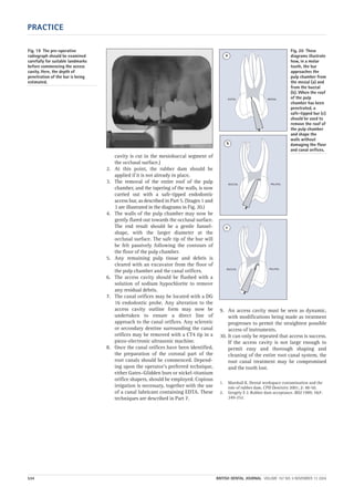 PRACTICE
534 BRITISH DENTAL JOURNAL VOLUME 197 NO. 9 NOVEMBER 13 2004
cavity is cut in the mesiobuccal segment of
the occlusal surface.)
2. At this point, the rubber dam should be
applied if it is not already in place.
3. The removal of the entire roof of the pulp
chamber, and the tapering of the walls, is now
carried out with a safe-tipped endodontic
access bur, as described in Part 5. (Stages 1 and
3 are illustrated in the diagrams in Fig. 20.)
4. The walls of the pulp chamber may now be
gently flared out towards the occlusal surface.
The end result should be a gentle funnel-
shape, with the larger diameter at the
occlusal surface. The safe tip of the bur will
be felt passively following the contours of
the floor of the pulp chamber.
5. Any remaining pulp tissue and debris is
cleared with an excavator from the floor of
the pulp chamber and the canal orifices.
6. The access cavity should be flushed with a
solution of sodium hypochlorite to remove
any residual debris.
7. The canal orifices may be located with a DG
16 endodontic probe. Any alteration to the
access cavity outline form may now be
undertaken to ensure a direct line of
approach to the canal orifices. Any sclerotic
or secondary dentine surrounding the canal
orifices may be removed with a CT4 tip in a
piezo-electronic ultrasonic machine.
8. Once the canal orifices have been identified,
the preparation of the coronal part of the
root canals should be commenced. Depend-
ing upon the operator’s preferred technique,
either Gates–Glidden burs or nickel-titanium
orifice shapers, should be employed. Copious
irrigation is necessary, together with the use
of a canal lubricant containing EDTA. These
techniques are described in Part 7.
9. An access cavity must be seen as dynamic,
with modifications being made as treatment
progresses to permit the straightest possible
access of instruments.
10. It can only be repeated that access is success.
If the access cavity is not large enough to
permit easy and thorough shaping and
cleaning of the entire root canal system, the
root canal treatment may be compromised
and the tooth lost.
1. Marshall K. Dental workspace contamination and the
role of rubber dam. CPD Dentistry 2001; 2: 48-50.
2. Gergely E J. Rubber dam acceptance. BDJ 1989; 167:
249-252.
Fig. 20 These
diagrams illustrate
how, in a molar
tooth, the bur
approaches the
pulp chamber from
the mesial (a) and
from the buccal
(b). When the roof
of the pulp
chamber has been
penetrated, a
safe-tipped bur (c)
should be used to
remove the roof of
the pulp chamber
and shape the
walls without
damaging the floor
and canal orifices.
DISTAL MESIAL
BUCCAL PALATAL
BUCCAL PALATAL
a
b
c
Fig. 19 The pre-operative
radiograph should be examined
carefully for suitable landmarks
before commencing the access
cavity. Here, the depth of
penetration of the bur is being
estimated.
09p527-534.qxd 27/10/2004 09:30 Page 534
 