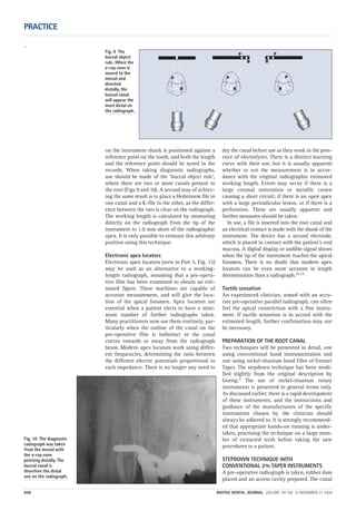 `
PRACTICE
608 BRITISH DENTAL JOURNAL VOLUME 197 NO. 10 NOVEMBER 27 2004
on the instrument shank is positioned against a
reference point on the tooth, and both the length
and the reference point should be noted in the
records. When taking diagnostic radiographs,
use should be made of the ‘buccal object rule’,
where there are two or more canals present in
the root (Figs 9 and 10). A second way of achiev-
ing the same result is to place a Hedstroem file in
one canal and a K-file in the other, as the differ-
ence between the two is clear on the radiograph.
The working length is calculated by measuring
directly on the radiograph from the tip of the
instrument to 1.0 mm short of the radiographic
apex. It is only possible to estimate this arbitrary
position using this technique.
Electronic apex locators
Electronic apex locators (seen in Part 5, Fig. 15)
may be used as an alternative to a working-
length radiograph, assuming that a pre-opera-
tive film has been examined to obtain an esti-
mated figure. These machines are capable of
accurate measurement, and will give the loca-
tion of the apical foramen. Apex locators are
essential when a patient elects to have a mini-
mum number of further radiographs taken.
Many practitioners now use them routinely, par-
ticularly when the outline of the canal on the
pre-operative film is indistinct or the canal
curves towards or away from the radiograph
beam. Modern apex locators work using differ-
ent frequencies, determining the ratio between
the different electric potentials proportional to
each impedance. There is no longer any need to
dry the canal before use as they work in the pres-
ence of electrolytes. There is a distinct learning
curve with their use, but it is usually apparent
whether or not the measurement is in accor-
dance with the original radiographic estimated
working length. Errors may occur if there is a
large coronal restoration or metallic crown
causing a short circuit; if there is an open apex
with a large periradicular lesion, or if there is a
perforation. These are usually apparent and
further measures should be taken.
In use, a file is inserted into the root canal and
an electrical contact is made with the shank of the
instrument. The device has a second electrode,
which is placed in contact with the patient’s oral
mucosa. A digital display or audible signal shows
when the tip of the instrument reaches the apical
foramen. There is no doubt that modern apex
locators can be even more accurate in length
determination than a radiograph.11,12
Tactile sensation
An experienced clinician, armed with an accu-
rate pre-operative parallel radiograph, can often
feel the apical constriction with a fine instru-
ment. If tactile sensation is in accord with the
estimated length, further confirmation may not
be necessary.
PREPARATION OF THE ROOT CANAL
Two techniques will be presented in detail, one
using conventional hand instrumentation and
one using nickel-titanium hand Files of Greater
Taper. The stepdown technique has been modi-
fied slightly from the original description by
Goerig.2 The use of nickel-titanium rotary
instruments is presented in general terms only.
As discussed earlier, there is a rapid development
of these instruments, and the instructions and
guidance of the manufacturers of the specific
instruments chosen by the clinician should
always be adhered to. It is strongly recommend-
ed that appropriate hands-on training is under-
taken, practising the technique on a large num-
ber of extracted teeth before taking the new
procedures to a patient.
STEPDOWN TECHNIQUE WITH
CONVENTIONAL 2% TAPER INSTRUMENTS
A pre-operative radiograph is taken, rubber dam
placed and an access cavity prepared. The canal
Fig. 10 The diagnostic
radiograph was taken
from the mesial with
the x-ray cone
pointing distally. The
buccal canal is
therefore the distal
one on the radiograph.
Fig. 9 The
buccal object
rule. When the
x-ray cone is
moved to the
mesial and
directed
distally, the
buccal canal
will appear the
most distal on
the radiograph.
10p603-613.qxd 26/10/2004 14:59 Page 608
 