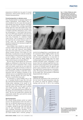 Fig. 12 A diagrammatic illustration
of the sequence of instruments in a
conventional 2% taper hand file
canal preparation.
PRACTICE
BRITISH DENTAL JOURNAL VOLUME 197 NO. 10 NOVEMBER 27 2004 609
preparation is divided into two parts: i) coronal
preparation, which permits radicular access for
ii) apical instrumentation.
Coronal preparation or radicular access
First, the pulp chamber is copiously irrigated with
sodium hypochlorite. Gates–Glidden burs are
next introduced into the canal, directed apically
and laterally away from the furcation. The larger
sizes are introduced first, working sequentially
further down the canal with smaller sizes. Some
canals will accept a size 6 bur, but normally a size
4 would be used first, followed by a size 3. Each
bur will penetrate 2–3 mm further than the pre-
vious one. EDTA paste should be used with each
bur, and the canal should be irrigated between
each entry. Eventually, in a relatively straight
canal, the No. 2 bur is inserted 10–12 mm into
the canal from the occlusal reference point. In a
curved canal the pre-operative radiograph
should be checked for the maximum straight line
penetration of the bur.
Gates–Glidden burs should be rotated with
constant medium drill speed from the time they
enter the canal until removed. Gates-Glidden
burs must not be taken into a curve, or they will
almost certainly fracture. If the shank of a bur
does break, it usually does so near the handpiece
head and may be retrieved easily from the tooth,
as seen in Figure 11. However, if the head does
become separated from the shank within the
canal, removal may be extremely difficult.13
The bur may be flexed against the canal wall
slightly on withdrawal to ensure that the natural
shape of the canal is maintained. Thus a round
canal will remain round, but an oval canal will
be prepared to a smooth oval funnel. A wide oval
or ‘figure-of-eight’ shape may need preparing at
both extremities to produce a wide flare. Instru-
mentation with the stepdown technique in the
radicular access is accomplished using only light
pressure directed apically and away from the
furcation, or perforation may result.
An alternative to Gates–Glidden burs is the
use of standard flexible K-type files with safe
tips, used with the balanced force technique. Fol-
lowing initial widening of the mouth of the
canal only with a Gates–Glidden bur, the largest
hand file which will enter the canal is selected
and worked apically, using EDTA paste as a
lubricant. Once penetration proves difficult the
file should not be forced further, or fracture may
result. The next size smaller file is selected, and
sequentially smaller files used until the coronal
preparation is complete.
Apical preparation
The coronal flaring already carried out makes
access to the apical portion of the root easier, as
there are no dentinal obstructions and access is
more direct. Thus, once the coronal preparation
is complete, flexible K-type files with safe tips
may be used sequentially with the balanced
force technique previously described. A size
appropriate to the particular canal and the final
size Gates–Glidden drill is selected, perhaps a
size 60, the tip dipped into a canal lubricant, and
the instrument worked slightly further into the
canal. Sequentially smaller files are selected
until the canal is prepared to 3–4 mm short of
the estimated working length. Now the actual
working length must be confirmed by one of the
methods described earlier, radiograph or apex
locator. Once the working length has been con-
firmed, the apical preparation can be completed.
In narrow or sclerosed canals the operator may
prefer to take a small 08, 10 and 15 files to work-
ing length before commencing any canal prepa-
ration. The prepared canal then acts as guidance
for the larger sizes. This procedure is illustrated
diagrammatically in Figure 12.
Stepback technique
Following the preparation of the coronal part of
the root canal, the apical preparation may also
be carried out using the stepback technique.
Starting with the size 15 file at the working
Fig. 11 A Gates-Glidden bur which
fractured during use in the root
canal, showing the normal point of
separation, permitting removal with
Steiglitz forceps. However, b) shows
that this is not always the case.
a
b
1 Gates-Glidden #4
irrigate
2 Gates-Glidden #3
irrigate
3 Gates-Glidden #2
irrigate
4 K-flex type file #60
irrigate
5 K-flex type file #55
irrigate
6 K-flex type file #45
irrigate
7 K-flex type file #40
irrigate
When 3mm from estimated
working length verify actual
working length with x-ray or
apex locator.
8 K-flex type file #35
irrigate
9 K-flex type file #30
irrigate with EDTA
irrigate & dry
10p603-613.qxd 26/10/2004 14:59 Page 609
 