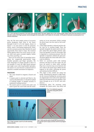 Fig. 6 Gutta-percha points should NOT be presented to
the operator by the surgery assistant with the tips dipped
in sealer.
Fig. 5 Finger spreaders sized A to D with matching
accessory points.
Fig. 4 An endodontic gauge for
accurately sizing gutta-percha
points.
(Fig. 3b). The most simple system of accessory
points designates these from A, the finest,
through B and C to D, the largest, shown in
Figure 5. As each point is used the prepared,
flared, canal is becoming progressively wider,
and the accessory points may therefore be used
sequentially from small to large. The resultant
filling appears above the access cavity as a spi-
ral, with each point extruded slightly further
out of the canal (Fig. 3c).
There are two main types of spreading instru-
ments for compacting gutta-percha: long-
handled spreaders and finger spreaders. The
main advantage of a finger spreader is that it is
not possible to exert the high lateral pressure
that might occur with long-handled spreaders.
The chance of a root fracture is reduced and it is
therefore a suitable instrument for beginners.
PROCEDURE
1. The canal should be irrigated, cleaned and
dried.
2. A master point is selected and fitted to the
canal as described above. It should be marked
at working length, or grasped securely in
endodontic locking tweezers.
3. The master point is coated with sealer and
used to paste the canal walls with the sealer,
using an in-out movement, before seating
the point home into the canal at full work-
ing length.
4. A fine finger spreader is selected and the rub-
ber stop set to working length. Place the
spreader alongside the master point and com-
pact using firm apical finger pressure only.
Leave the spreader in situ for 30 seconds. This
is important as continuous pressure from the
spreader is required to deform the gutta-per-
cha point against the canal walls and to over-
come its elasticity.
5. Select an accessory point with locking
tweezers and dip its tip into sealer. Do not
leave the points in sealer while working
(Fig. 6) as a reaction may occur between the
zinc oxide in the points (up to 80%) and the
eugenol in the sealer, softening the points
and making insertion difficult.
6. This stage is best carried out using two
hands. Assuming the operator is right hand-
ed, the tweezers holding the accessory point
are aligned above the tooth in the right hand,
while the left hand rotates the spreader a few
times through an arc of 30–40° and with-
draws it.
7. Immediately place the accessory point
alongside the master point. Any delay will
PRACTICE
BRITISH DENTAL JOURNAL VOLUME 197 NO. 11 DECEMBER 11 2004 669
Fig. 3 a) In cold lateral compaction, the master point should exhibit ‘tug-back’ slightly short of the working lengths. (Paper points have been placed to protect
the other canals.) b) A finger spreader inserted alongside the master point, is left in place for 30 seconds. c) The spiral of successive accessory points in an
effective obturation.
a b c
11p667-672.qxd 09/11/2004 14:08 Page 669
 