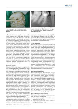 There is still controversy, however, over the
correct treatment of a deep, caries free, cavity,
lying close to the pulp. As alluded to in Part 1, the
essential treatment is to ensure that there can be
no bacterial contamination of the pulp via the
exposed dentine tubules.11 This may be achieved
by either a lining of glass-ionomer cement, or the
use of an acid-etched dentine bonding system.
Some workers have recommended washing the
cavity with sodium hypochlorite to further disin-
fect the dentine surface, and this seems an emi-
nently sensible suggestion. Until further research
provides conclusive evidence for or against, how-
ever, the use of an indirect pulp cap of calcium
hydroxide is recommended in these situations.
The calcium hydroxide cement provides a bacteri-
cidal effect on any remaining bacteria and may
encourage the formation of secondary dentine
and of a dentine bridge. It is certainly no longer
considered necessary to reopen the cavity at a
later date to confirm healing.
Direct pulp capping
The aim of direct pulp capping is to protect the
vital pulp which has been exposed during cavity
preparation, either through caries or trauma. The
most important consideration in obtaining suc-
cess is that the pulp tissue remains uncontami-
nated. In deep cavities, when an exposure may be
anticipated, all caries should be removed before
approaching the pulpal aspect of the cavity floor.
If an exposure of the pulp occurs in a carious
field the chances of successful pulp capping are
severely compromised. A rubber dam should be
applied as soon as pulp capping is proposed. The
pulp should be symptom-free and uninfected,
and the exposure should be small. Before com-
mencing large restorations in suspicious teeth it
may be prudent to test the vitality of the tooth
with an electronic pulp tester, and also to expose
a radiograph to ensure that there is no evidence
of pulpal or periapical pathology. The radiograph
may in fact be more valuable, as misleading
results may occur when using an electric pulp
tester on compromised multirooted teeth.
If the above criteria have been met and pulp
capping is indicated, the cavity should be cleaned
thoroughly, ideally with sodium hypochlorite
solution, and pulpal haemorrhage arrested with
sterile cotton pledgets. Persistent bleeding indi-
cates an inflamed pulp, which may not respond to
treatment. After placing the calcium hydroxide,
the area must be sealed against bacterial ingress,
preferably with a glass-ionomer lining.
Partial pulpotomy
Although the technique of pulpotomy is indicated
for immature teeth with open apices, as described
in Part 10, it cannot be recommended routinely in
mature teeth. However, the technique of partial
pulpotomy (a procedure between pulp capping
and pulpotomy) was introduced by Cvek and has
been shown to be very successful in the treatment
of traumatically exposed pulps.12,13 The exposed
pulp and surrounding dentine is removed under
rubber dam isolation with a high-speed diamond
drill and copious irrigation using sterile saline, to
a depth of about 2 mm. Haemostasis is achieved
and the wound dressed with a non-setting calci-
um hydroxide paste, either powder and sterile
saline or a proprietory paste. The cavity is sealed
with a suitable lining, such as resin-modified
glass-ionomer cement, and restored convention-
ally. The tooth should be carefully monitored.
Mineral trioxide aggregate
Although the majority of practitioners will use
calcium hydroxide routinely and effectively for
pulp capping and various repairs to the root,
Mineral trioxide aggregate (MTA) is increasingly
used in specialist and some general practices. The
material is described briefly in Part 5, and the
application discussed in Part 11. Early research as
a root-end filling material showed unparalleled
results, and workers have since reported similar
success in other endodontic procedures, with no
resulting inflammation, and deposition of
cementum over the restorative material.14–16
MTA can be used in place of hard-setting calcium
hydroxide in all these pulp-capping procedures.
Root-end induction (apexification)
The cases in which partial or total closure of an
open apex can be achieved are:
1. vital radicular pulp in an immature tooth
pulpotomy (see Part 10);
2. pulpless immature tooth with or without a
periapical radiolucent area.
PRACTICE
BRITISH DENTAL JOURNAL VOLUME 197 NO. 12 DECEMBER 25 2004 737
Fig. 3 A paper point may be used to condense the
calcium hydroxide in the canal and remove excess
moisture
Fig. 4 A radiograph showing root canal system filled with
calcium hydroxide, which has the same radio-density as
the dentine. Any part of the canal not filled with the
paste appears as a void
12p735-743.qxd 19/11/2004 11:41 Page 737
 