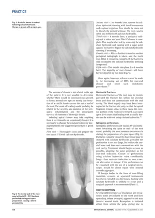 The success of closure is not related to the age
of the patient. It is not possible to determine
whether there would be continued root growth
to form a normal root apex or merely the forma-
tion of a calcific barrier across the apical end of
the root. The mode of healing would probably be
related to the severity and duration of the peri-
apical inflammation and the consequent
survival of elements of Hertwig’s sheath.
Inducing apical closure may take anything
from 6 to 18 months or occasionally longer. It is
necessary to change the calcium hydroxide dur-
ing treatment; the suggested procedure is given
below:
First visit — Thoroughly clean and prepare the
root canal. Fill with calcium hydroxide.
Second visit — 2 to 4 weeks later, remove the cal-
cium hydroxide dressing with hand instruments
and copious irrigation. Care should be taken not
to disturb the periapical tissue. The root canal is
dried and refilled with calcium hydroxide.
Third visit — 6 months later, a periapical radi-
ograph is taken and root filled if closure is com-
plete. This may be checked by removing the cal-
cium hydroxide and tapping with a paper point
against the barrier. Repeat the calcium hydroxide
dressing if necessary.
Fourth visit — After a further 6 months another
periapical radiograph is taken, and the tooth
root-filled if closure is complete. If the barrier is
still incomplete the calcium hydroxide dressing
is repeated.
Fifth visit — This should take place 3 to 6 months
later. The majority of root closures will have
been completed by this time (Fig. 5).
Once again, however, reference must be made
to the increasing use of MTA for root-end
closure and other such endodontic
procedures.17
Horizontal fractures
Horizontal fractures of the root may be treated,
provided the fracture lies within the alveolar
bone and does not communicate with the oral
cavity. The blood supply may have been inter-
rupted at the fracture site only, so that the apical
fragment remains vital. In these cases, the coro-
nal portion of the root can be treated as an open
apex. Cvek states that healing with a calcific bar-
rier can be achieved using calcium hydroxide.15
Iatrogenic perforations
Iatrogenic perforations are caused by an instru-
ment breaching the apex or wall of the root
canal; probably the most common occurrence is
during the preparation of a post space (Fig. 6).
Partial or complete closure by hard tissue may be
induced with calcium hydroxide, provided the
perforation is not too large, lies within the cre-
stal bone and does not communicate with the
oral cavity. Treatment should begin as soon as
possible, adopting the same procedure as for
root-end induction. Closure of perforations
using calcium hydroxide takes considerably
longer than root-end induction in most cases.
An alternative technique, if the perforation can
be visualised with the use of a surgical micro-
scope, would be direct repair with mineral
trioxide aggregate.
If foreign bodies in the form of root-filling
materials, cements or separated instruments
have been extruded into the tissues, healing with
calcium hydroxide is unlikely to occur and a
surgical approach is recommended (Part 11).
ROOT RESORPTION
Several different types of resorption are recog-
nised: some are isolated to one tooth and slow
spreading, others are rapid, aggressive and may
involve several teeth. Resorption is initiated
either from within the pulp, giving rise to
PRACTICE
738 BRITISH DENTAL JOURNAL VOLUME 197 NO. 12 DECEMBER 25 2004
Fig. 5 A calcific barrier is evident
following calcium hydroxide
therapy in a case with an open apex
Fig. 6 The mesial wall of the root
canal at tooth UL1 (21) has been
perforated during post space
preparation, causing a lateral
periodontitis
12p735-743.qxd 19/11/2004 11:43 Page 738
 