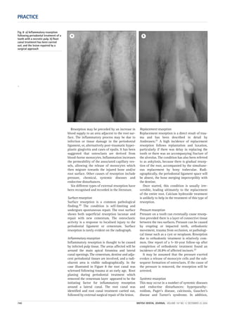 `
PRACTICE
740 BRITISH DENTAL JOURNAL VOLUME 197 NO. 12 DECEMBER 25 2004
Resorption may be preceded by an increase in
blood supply to an area adjacent to the root sur-
face. The inflammatory process may be due to
infection or tissue damage in the periodontal
ligament, or, alternatively post-traumatic hyper-
plastic gingivitis and cases of epulis. It has been
suggested that osteoclasts are derived from
blood-borne monocytes. Inflammation increases
the permeability of the associated capillary ves-
sels, allowing the release of monocytes which
then migrate towards the injured bone and/or
root surface. Other causes of resorption include
pressure, chemical, systemic diseases and
endocrine disturbances.
Six different types of external resorption have
been recognised and recorded in the literature.
Surface resorption
Surface resorption is a common pathological
finding.20 The condition is self-limiting and
undergoes spontaneous repair. The root surface
shows both superficial resorption lacunae and
repair with new cementum. The osteoclastic
activity is a response to localised injury to the
periodontal ligament or cementum. Surface
resorption is rarely evident on the radiograph.
Inflammatory resorption
Inflammatory resorption is thought to be caused
by infected pulp tissue. The areas affected will be
around the main apical foramina and lateral
canal openings. The cementum, dentine and adja-
cent periodontal tissues are involved, and a radi-
olucent area is visible radiographically. In the
case illustrated in Figure 8 the root canal was
sclerosed following trauma at an early age. Root
planing during periodontal treatment which
removed the cementum layer appeared to be the
initiating factor for inflammatory resorption
around a lateral canal. The root canal was
identified and root canal treatment carried out,
followed by external surgical repair of the lesion.
Replacement resorption
Replacement resorption is a direct result of trau-
ma and has been described in detail by
Andreasen.21 A high incidence of replacement
resorption follows replantation and luxation,
particularly if there was delay in replacing the
tooth or there was an accompanying fracture of
the alveolus. The condition has also been referred
to as ankylosis, because there is gradual resorp-
tion of the root, accompanied by the simultane-
ous replacement by bony trabeculae. Radi-
ographically, the periodontal ligament space will
be absent, the bone merging imperceptibly with
the dentine.
Once started, this condition is usually irre-
versible, leading ultimately to the replacement
of the entire root. Calcium hydroxide treatment
is unlikely to help in the treatment of this type of
resorption.
Pressure resorption
Pressure on a tooth can eventually cause resorp-
tion provided there is a layer of connective tissue
between the two surfaces. Pressure can be caused
by erupting or impacted teeth, orthodontic
movement, trauma from occlusion, or pathologi-
cal tissue such as a cyst or neoplasm. Resorption
due to orthodontic treatment is relatively com-
mon. One report of a 5–10-year follow-up after
completion of orthodontic treatment found an
incidence of 28.8% of affected incisors.22
It may be assumed that the pressure exerted
evokes a release of monocyte cells and the sub-
sequent formation of osteoclasts. If the cause of
the pressure is removed, the resorption will be
arrested.
Systemic resorption
This may occur in a number of systemic diseases
and endocrine disturbances: hyperparathy-
roidism, Paget’s disease, calcinosis, Gaucher’s
disease and Turner’s syndrome. In addition,
Fig. 8 a) Inflammatory resorption
following periodontal treatment of a
tooth with a necrotic pulp. b) Root
canal treatment has been carried
out, and the lesion repaired by a
surgical approach
ba
12p735-743.qxd 19/11/2004 11:45 Page 740
 