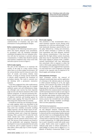 Radiographs, which are essential prior to the
commencement of treatment, may give little
information of early pathological changes.
Before commencing treatment
The majority of the following restorative proce-
dures will require adequate local anaesthesia.
In accordance with the biological principles
established throughout this text, adequate isola-
tion will also be necessary to prevent salivary
contamination. A rubber dam should be placed,
and isolation completed with cotton wool rolls
and saliva ejector as seen in Figure 5.
Indirect pulp capping
The aim of this treatment is to maintain the
vitality of the pulp in a deep carious lesion,
when there is no direct pulpal involvement. All
the carious dentine must be removed, and a thin
layer of sound, non-carious dentine must
remain. A lining of setting calcium hydroxide
is placed, which stimulates the formation of
secondary dentine. The tooth is restored over
the dressing with a permanent restorative
material.
It has been suggested that other medicaments
may be used for indirect pulp caps, for example
antibiotic pastes and anti-inflammatory drugs,
but although some success has been reported,
pulp necrosis and abscess formation often result
without symptoms. As with the permanent den-
tition, research is presently focussing on the use
of adhesive materials and bonding agents for
indirect pulp capping. The long-term results of
these long-term clinical trials are awaited.
It should be noted that one technique for indi-
rect pulp capping, which was described in the
past, is no longer recommended. This was where
deep caries was carefully excavated, avoiding
pulpal exposure, and the deeper layers of soft-
ened dentine dressed with a calcium hydroxide-
containing cement and a long-term temporary
dressing. After a period of 6–8 weeks the tooth,
which should have been symptomless, was
reopened, and the arrested carious lesion exam-
ined. The success of this treatment was found to
be less predictable and symptoms frequently
developed. It is now recommended that all caries
be removed, and if a pulpal exposure is found
then either a direct pulp cap or a form of pulpo-
tomy is used.
Direct pulp capping
This treatment is only recommended when a
small traumatic exposure occurs, during cavity
preparation of a vital non-infected pulp.2 A cal-
cium hydroxide dressing is placed directly over
the pulp, followed by a lining and restoration,
and the whole technique is carried out using
local anaesthesia and with adequate isolation
from salivary contamination. It has been sug-
gested that the high cellular content of primary
pulp tissue may be responsible for the failure of
direct pulp capping in primary teeth.3 Undiffer-
entiated mesenchymal cells may differentiate
into osteoclastic cells in response to either the
caries or direct pulp capping which leads to inter-
nal resorption. It is also suggested that exposures
on axial walls have a poor prognosis as the pulp
coronal to the exposure may be deprived of its
blood supply and undergo necrosis.
Vital pulpotomy techniques
These techniques involve the removal of
inflamed coronal pulp tissue and the application
of a dressing to the radicular pulp in an attempt
to either promote healing of, or fix, the upper
portions, and to preserve the vitality of the apical
tissue. Because of the difficulties involved in
diagnosing the condition of the pulp tissue histo-
logically before the commencement of treatment,
careful assessment must be made at each stage of
the procedure. Whenever the haemorrhage from
the radicular pulp stumps is profuse and uncon-
trolled, the assumption is made that the inflam-
matory process has extended into the radicular
tissue, and the therapy modified accordingly.
There are three pulpotomy techniques.
Vital formocresol pulpotomy
The treatment is carried out using local anaesthe-
sia and adequate isolation. Following cavity
preparation in the normal manner, the deep caries
is removed and the coronal pulp chamber opened,
such that there is no overhanging dentine inhibit-
ing the complete removal of the pulp tissue. The
coronal tissue is removed using a large excavator
or sterile rosehead bur. If a high-speed diamond
bur is used it should be cooled with sterile water
or saline. Sterile cotton wool is applied to the
radicular pulp tissue to achieve haemostasis. A
small pledget of cotton wool is dipped in a 1:5
dilution of Buckley’s formocresol (Table 1) and
PRACTICE
Fig, 5 A deciduous molar with a deep
carious lesion has been isolated prior
to commencing endodontic therapy.
BRITISH DENTAL JOURNAL VOLUME 198 NO. 1 JANUARY 8 2005 11
Endo_Chapter_10.qxd 10/12/2004 14:03 Page 11
 
