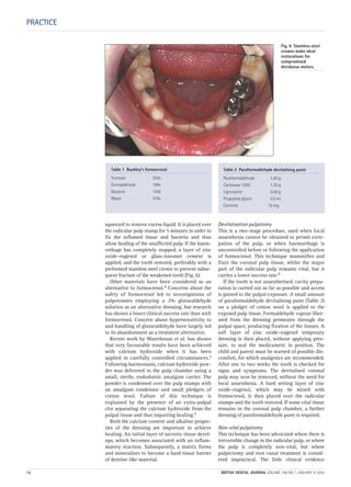 squeezed to remove excess liquid. It is placed over
the radicular pulp stump for 5 minutes in order to
fix the inflamed tissue and bacteria and thus
allow healing of the unaffected pulp. If the haem-
orrhage has completely stopped, a layer of zinc
oxide–eugenol or glass-ionomer cement is
applied, and the tooth restored, preferably with a
preformed stainless steel crown to prevent subse-
quent fracture of the weakened tooth (Fig. 6).
Other materials have been considered as an
alternative to formocresol.4 Concerns about the
safety of formocresol led to investigations of
pulpotomies employing a 2% glutaraldehyde
solution as an alternative dressing, but research
has shown a lower clinical success rate than with
formocresol. Concern about hypersensitivity to
and handling of glutaraldehyde have largely led
to its abandonment as a treatment alternative.
Recent work by Waterhouse et al. has shown
that very favourable results have been achieved
with calcium hydroxide when it has been
applied in carefully controlled circumstances.5
Following haemostasis, calcium hydroxide pow-
der was delivered to the pulp chamber using a
small, sterile, endodontic amalgam carrier. The
powder is condensed over the pulp stumps with
an amalgam condensor and small pledgets of
cotton wool. Failure of this technique is
explained by the presence of an extra-pulpal
clot separating the calcium hydroxide from the
pulpal tissue and thus impairing healing.3
Both the calcium content and alkaline proper-
ties of the dressing are important to achieve
healing. An initial layer of necrotic tissue devel-
ops, which becomes associated with an inflam-
matory reaction. Subsequently, a matrix forms
and mineralises to become a hard tissue barrier
of dentine-like material.
Devitalisation pulpotomy
This is a two-stage procedure, used when local
anaesthesia cannot be obtained to permit extir-
pation of the pulp, or when haemorrhage is
uncontrolled before or following the application
of formocresol. This technique mummifies and
fixes the coronal pulp tissue, whilst the major
part of the radicular pulp remains vital, but it
carries a lower success rate.6
If the tooth is not anaesthetised, cavity prepa-
ration is carried out as far as possible and access
is gained to the pulpal exposure. A small amount
of paraformaldehyde devitalising paste (Table 2)
on a pledget of cotton wool is applied to the
exposed pulp tissue. Formaldehyde vapour liber-
ated from the dressing permeates through the
pulpal space, producing fixation of the tissues. A
soft layer of zinc oxide–eugenol temporary
dressing is then placed, without applying pres-
sure, to seal the medicament in position. The
child and parent must be warned of possible dis-
comfort, for which analgesics are recommended.
After one to two weeks the tooth is checked for
signs and symptoms. The devitalised coronal
pulp may now be removed, without the need for
local anaesthesia. A hard setting layer of zinc
oxide–eugenol, which may be mixed with
formocresol, is then placed over the radicular
stumps and the tooth restored. If some vital tissue
remains in the coronal pulp chamber, a further
dressing of paraformaldehyde paste is required.
Non-vital pulpotomy
This technique has been advocated where there is
irreversible change in the radicular pulp, or where
the pulp is completely non-vital, but where
pulpectomy and root canal treatment is consid-
ered impractical. The little clinical evidence
PRACTICE
Fig. 6 Stainless steel
crowns make ideal
restorations for
compromised
deciduous molars.
Table 1 Buckley’s formocresol
Tricresol 35%
Formaldehyde 19%
Glycerol 15%
Water 31%
Table 2 Paraformaldehyde devitalising paste
Paraformaldehyde 1.00 g
Carbowax 1500 1.30 g
Lignocaine 0.06 g
Propylene glycol 0.5 ml
Carmine 10 mg
12 BRITISH DENTAL JOURNAL VOLUME 198 NO. 1 JANUARY 8 2005
Endo_Chapter_10.qxd 10/12/2004 14:04 Page 12
 