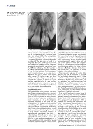PRACTICE
with no sensation to the patient indicating clo-
sure, or will press against soft granulation tissue
which the patient will feel. The average time
taken for closure is 6 months.
If no barrier is detected, the calcium hydroxide
is replaced. If the open apex is found to be
completely closed, the canal may be obturated
with gutta-percha and sealer. Closure of an open
apex may be anticipated in over 90% of cases
treated by this technique, with a 4-year progno-
sis of 85%.10 Obturation may then be completed
by one of several methods. Conventional cold
lateral compaction may be used, perhaps invert-
ing a large gutta-percha point to obtain a good
apical tug-back. A custom gutta-percha point
may be made by rolling several GP points
together after softening in solvent or gentle
heat, and repeated fitting to the canal, carefully
marking the orientation at insertion. However,
injectable thermo-plasticised gutta-percha may
be the most suitable obturation medium.
First permanent molar
The first permanent molar may, soon after erup-
tion, show extensive caries, sometimes associat-
ed with hypoplasia. Consideration must be given
to the age of the patient and the dental develop-
ment, the occlusion and possible need for ortho-
dontic treatment, as well as the long-term
restorative prognosis of the tooth and the
patient’s ability to tolerate involved treatment
over a long period. Where necessary, planned
extractions should be considered. The primary
aim of conservation is to ensure that root growth
continues with completion of apical formation,
so that definitive endodontic treatment, if
required, may be carried out at a later stage.
The vitality of the tooth must be assessed and
radiographs should be available, showing the
extent of carious involvement and the state of
the periapical tissues. It is essential that a local
anaesthetic is administered and salivary control
achieved by adequate isolation. Caries should be
excavated and the tooth treated in accordance
with conventional protocols. If a small exposure
of a vital tooth occurs, either accidentally during
cavity preparation or because of caries, and the
surrounding tissue is healthy, a direct pulp cap
with calcium hydroxide cement may be applied.
A lining of glass-ionomer cement is then placed
to seal the dentine tubules prior to the definitive
restoration. If amalgam is used, a dentine bond-
ing system should be considered to ensure
complete sealing of the restoration.
If the exposure is large and the vitality of the
radicular pulp is to be maintained to allow for
root development, a pulpotomy may be carried
out. Following the opening of the coronal pulp
chamber and the removal of the pulp tissue, the
area is irrigated and dried. Haemostasis of the
radicular pulp should be observed prior to the
application of calcium hydroxide cement or
paste, and the provision of a permanent restora-
tion. A calcific barrier should develop adjacent
to the dressing, and root development continue
in the presence of healthy pulp tissue.
If the pulp of a young, permanent molar is
found to be non-vital, endodontic treatment
should be undertaken only after careful assess-
ment of the developing occlusion, the condition
of the comparable teeth, the patient’s ability to
cooperate and the long-term prognosis of the
tooth. If pulpal necrosis occurs prior to the com-
plete development of the apex, the objective of
treatment, as described earlier, is to encourage
further deposition of calcified tissue in the apical
region. Thorough preparation of the root canals
is carried out, avoiding damage to the apical tis-
sues and cells of Hertwig’s root sheath. Calcium
hydroxide is then applied as previously
described. Definitive endodontic treatment is
carried out when an apical barrier has formed
and the tooth is then permanently restored. If
symptoms arise in fully developed, young,
Fig. 7 a) An immature tooth with a
non-vital pulp has been filled with
calcium hydroxide b).
a b
14 BRITISH DENTAL JOURNAL VOLUME 198 NO. 1 JANUARY 8 2005
Endo_Chapter_10.qxd 10/12/2004 14:06 Page 14
 