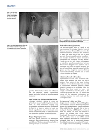 possible. Alternatively, if these new techniques
are not employed, greater consideration
should be given to referral for specialist surgical
treatment.
INDICATIONS FOR SURGICAL INTERVENTION
Although endodontic surgery is carried out
primarily in cases of failed orthograde treatment,
there are other indications. Surgery may
be necessary to establish drainage, (considered
in Part 3); to biopsy a lesion; to repair any
defects or perforations in the tooth root; to resect
a multi-rooted tooth where, for technical reasons,
one of the roots cannot be successfully treated.
Biopsy of a periapical lesion
The one specific indication for endodontic
surgery is uncertainty about the nature of the
apical lesion. The lesion should be excised in its
entirety and sent for evaluation.
Root-end resection (apicectomy)
The term apicectomy refers to a stage of the
operation only. The principal objective is to seal
the canal system at the apical foramen from the
periradicular tissues. To do this it is necessary
to resect the apical part of the root to gain
access to the root canal, hence the term. Root-
end resection must be an adjunct measure to
orthograde root treatment for two reasons.
Firstly, there is very little chance of being able
to seal all the lateral communications between
the canal and the periodontal ligament with a
retrograde root-filling technique. Secondly, the
area of root-filling material exposed will be
greater and the long-term success affected,
because all root-filling materials are, to some
extent, irritant to the tissues.
Indications for root-end resection
Improvements in root canal treatment tech-
niques have lessened the need for apical
surgery. Cases which at first seem obvious
candidates for endodontic surgery may respond
to conventional treatment provided careful
thought is given to the aetiology. Once the
decision has been made to carry out
surgery, consideration must be given to the
chances of success (see Part 12). Access and
control of the operating environment are
essential, otherwise the end result will be
counterproductive.
Retreatment of a failed root filling
Surgery may be considered if a root filling fails
and retreatment cannot be effected by orthograde
means. There are a number of reasons why a root
filling might fail, but generally this is due to
inadequate cleansing and filling of the root canal.
Some root fillings can prove very difficult to
remove, for example hard setting pastes.
Occasionally there may be an anatomical reason
for the failure, such as an unfilled apical
delta. Attempts at retreatment by a conventional
orthograde route may be unsuccessful because
the original canal cannot be negotiated. Periradic-
ular surgery and root-end filling is therefore
PRACTICE
Fig. 3 The only way
that this extruded
filling material may
be removed is by a
surgical approach
Fig. 4 It would almost certainly be impossible to carry out
orthograde root canal treatment on this tooth
Fig. 5 The pulpal space in this tooth has
been obliterated following trauma.
Orthograde access proved impossible
72 BRITISH DENTAL JOURNAL VOLUME 198 NO. 2 JANUARY 22 2005
2p71-79.QXD 10/01/2005 11:31 Page 72
 