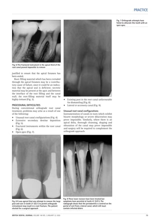 Fig. 9 These lower incisors have been treated but
symptoms have persisted at tooth 41 (LR1). The
radiograph shows that the periodontitis is centred on the
portal of exit from a lateral canal, which still must
contain infected debris
Fig. 8 It was agreed that any attempt to remove the large
post and core in tooth 21 (UL1) to permit orthograde
retreatment may result in a root fracture. The patient
elected for a surgical approach
justified to ensure that the apical foramen has
been sealed.
Root-filling material which has been extruded
through the apical foramen may be a contribu-
tory cause of failure, since it could be an indica-
tion that the apical seal is deficient; necrotic
material may be present at the apex and between
the interface of the root filling and the canal
wall; the root-filling material itself may be
highly irritant (Fig. 3).
PROCEDURAL DIFFICULTIES
During conventional orthograde root canal
treatment, problems may arise as a result of one
of the following:
• Unusual root canal configurations (Fig. 4).
• Extensive secondary dentine deposition
(Fig. 5).
• Fractured instruments within the root canal
(Fig. 6).
• Open apex (Fig. 7).
• Existing post in the root canal unfavourable
for dismantling (Fig. 8).
• Lateral or accessory canal (Fig. 9).
Unusual root canal configurations
Instrumentation of canals in roots which exhibit
bizarre morphology or severe dilaceration may
prove impossible. Similarly, where there is an
apical delta, thorough cleansing, shaping and
obturation of the canal may prove impossible
and surgery will be required to complement the
orthograde approach.
PRACTICE
Fig. 7 Orthograde attempts have
failed to obturate this tooth with an
open apex
Fig. 6 This fractured instrument in the apical third of the
root canal proved impossible to remove
BRITISH DENTAL JOURNAL VOLUME 198 NO. 2 JANUARY 22 2005 73
2p71-79.QXD 10/01/2005 11:32 Page 73
 