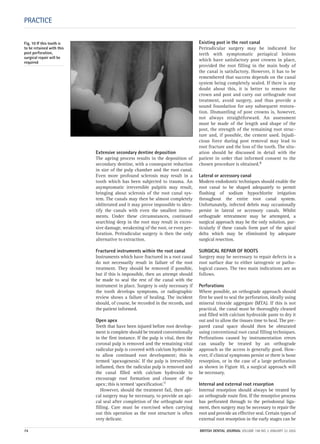 Extensive secondary dentine deposition
The ageing process results in the deposition of
secondary dentine, with a consequent reduction
in size of the pulp chamber and the root canal.
Even more profound sclerosis may result in a
tooth which has been subjected to trauma. An
asymptomatic irreversible pulpitis may result,
bringing about sclerosis of the root canal sys-
tem. The canals may then be almost completely
obliterated and it may prove impossible to iden-
tify the canals with even the smallest instru-
ments. Under these circumstances, continued
searching deep in the root may result in exces-
sive damage, weakening of the root, or even per-
foration. Periradicular surgery is then the only
alternative to extraction.
Fractured instruments within the root canal
Instruments which have fractured in a root canal
do not necessarily result in failure of the root
treatment. They should be removed if possible,
but if this is impossible, then an attempt should
be made to seal the rest of the canal with the
instrument in place. Surgery is only necessary if
the tooth develops symptoms, or radiographic
review shows a failure of healing. The incident
should, of course, be recorded in the records, and
the patient informed.
Open apex
Teeth that have been injured before root develop-
ment is complete should be treated conventionally
in the first instance. If the pulp is vital, then the
coronal pulp is removed and the remaining vital
radicular pulp is covered with calcium hydroxide
to allow continued root development; this is
termed ‘apexogenesis’. If the pulp is irreversibly
inflamed, then the radicular pulp is removed and
the canal filled with calcium hydroxide to
encourage root formation and closure of the
apex; this is termed ‘apexification’.7
However, should the treatment fail, then api-
cal surgery may be necessary, to provide an api-
cal seal after completion of the orthograde root
filling. Care must be exercised when carrying
out this operation as the root structure is often
very delicate.
Existing post in the root canal
Periradicular surgery may be indicated for
teeth with symptomatic periapical lesions
which have satisfactory post crowns in place,
provided the root filling in the main body of
the canal is satisfactory. However, it has to be
remembered that success depends on the canal
system being completely sealed. If there is any
doubt about this, it is better to remove the
crown and post and carry out orthograde root
treatment, avoid surgery, and thus provide a
sound foundation for any subsequent restora-
tion. Dismantling of post crowns is, however,
not always straightforward. An assessment
must be made of the length and shape of the
post, the strength of the remaining root struc-
ture and, if possible, the cement used. Injudi-
cious force during post removal may lead to
root fracture and the loss of the tooth. The situ-
ation should be discussed in detail with the
patient in order that informed consent to the
chosen procedure is obtained.8
Lateral or accessory canal
Modern endodontic techniques should enable the
root canal to be shaped adequately to permit
flushing of sodium hypochlorite irrigation
throughout the entire root canal system.
Unfortunately, infected debris may occasionally
persist in lateral or accessory canals. Whilst
orthograde retreatment may be attempted, a
surgical approach may be the only solution, par-
ticularly if these canals form part of the apical
delta which may be eliminated by adequate
surgical resection.
SURGICAL REPAIR OF ROOTS
Surgery may be necessary to repair defects in a
root surface due to either iatrogenic or patho-
logical causes. The two main indications are as
follows.
Perforations
Where possible, an orthograde approach should
first be used to seal the perforation, ideally using
mineral trioxide aggregate (MTA). If this is not
practical, the canal must be thoroughly cleaned
and filled with calcium hydroxide paste to dry it
out and to allow the tissues time to heal. The pre-
pared canal space should then be obturated
using conventional root canal filling techniques.
Perforations caused by instrumentation errors
can usually be treated by an orthograde
approach as the access is generally good. How-
ever, if clinical symptoms persist or there is bone
resorption, or in the case of a large perforation
as shown in Figure 10, a surgical approach will
be necessary.
Internal and external root resorption
Internal resorption should always be treated by
an orthograde route first. If the resorptive process
has perforated through to the periodontal liga-
ment, then surgery may be necessary to repair the
root and provide an effective seal. Certain types of
external root resorption in the early stages can be
PRACTICE
Fig. 10 If this tooth is
to be retained with this
post perforation,
surgical repair will be
required
74 BRITISH DENTAL JOURNAL VOLUME 198 NO. 2 JANUARY 22 2005
2p71-79.QXD 10/01/2005 11:33 Page 74
 