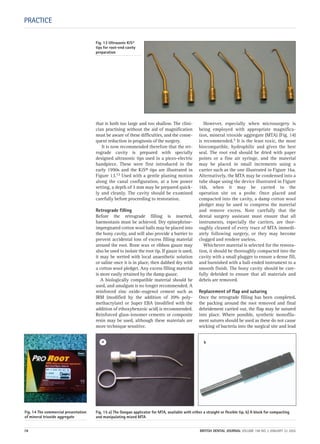 PRACTICE
that is both too large and too shallow. The clini-
cian practising without the aid of magnification
must be aware of these difficulties, and the conse-
quent reduction in prognosis of the surgery.
It is now recommended therefore that the ret-
rograde cavity is prepared with specially
designed ultrasonic tips used in a piezo-electric
handpiece. These were first introduced in the
early 1990s and the KiS® tips are illustrated in
Figure 13.12 Used with a gentle planing motion
along the canal configuration, at a low power
setting, a depth of 3 mm may be prepared quick-
ly and cleanly. The cavity should be examined
carefully before proceeding to restoration.
Retrograde filling
Before the retrograde filling is inserted,
haemostasis must be achieved. Dry epinephrine-
impregnated cotton wool balls may be placed into
the bony cavity, and will also provide a barrier to
prevent accidental loss of excess filling material
around the root. Bone wax or ribbon gauze may
also be used to isolate the root tip. If gauze is used,
it may be wetted with local anaesthetic solution
or saline once it is in place, then dabbed dry with
a cotton wool pledget. Any excess filling material
is more easily retained by the damp gauze.
A biologically compatible material should be
used, and amalgam is no longer recommended. A
reinforced zinc oxide–eugenol cement such as
IRM (modified by the addition of 20% poly-
methacrylate) or Super EBA (modified with the
addition of ethoxybenzoic acid) is recommended.
Reinforced glass-ionomer cements or composite
resin may be used, although these materials are
more technique sensitive.
However, especially when microsurgery is
being employed with appropriate magnifica-
tion, mineral trioxide aggregate (MTA) (Fig. 14)
is recommended.5 It is the least toxic, the most
biocompatible, hydrophilic and gives the best
seal. The root end should be dried with paper
points or a fine air syringe, and the material
may be placed in small increments using a
carrier such as the one illustrated in Figure 16a.
Alternatively, the MTA may be condensed into a
tube shape using the device illustrated in Figure
16b, when it may be carried to the
operation site on a probe. Once placed and
compacted into the cavity, a damp cotton wool
pledget may be used to compress the material
and remove excess. Note carefully that the
dental surgery assistant must ensure that all
instruments, especially the carriers, are thor-
oughly cleaned of every trace of MTA immedi-
ately following surgery, or they may become
clogged and rendere useless.
Whichever material is selected for the restora-
tion, it should be thoroughly compacted into the
cavity with a small plugger to ensure a dense fill,
and burnished with a ball-ended instrument to a
smooth finish. The bony cavity should be care-
fully debrided to ensure that all materials and
debris are removed.
Replacement of flap and suturing
Once the retrograde filling has been completed,
the packing around the root removed and final
debridement carried out, the flap may be sutured
into place. Where possible, synthetic monofila-
ment sutures should be used as these do not cause
wicking of bacteria into the surgical site and lead
Fig. 13 Ultrasonic KiS®
tips for root-end cavity
preparation
Fig. 14 The commercial presentation
of mineral trioxide aggregate
Fig. 15 a) The Dovgan applicator for MTA, available with either a straight or flexible tip. b) A block for compacting
and manipulating mixed MTA
a b
78 BRITISH DENTAL JOURNAL VOLUME 198 NO. 2 JANUARY 22 2005
2p71-79.QXD 10/01/2005 11:37 Page 78
 