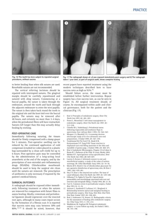 PRACTICE
to better healing than when silk sutures are used.
Resorbable sutures are not recommended.
The vertical relieving incisions should be
repaired with interrupted sutures. The gingival
margin should be carefully repositioned and
sutured with sling sutures. Commencing at a
buccal papilla, the suture is taken through the
embrasure, around the tooth and back through
the adjacent embrasure to enter the next papilla.
The suture is then taken back round the tooth to
the original site and the knot tied over the buccal
papilla. The sutures may be removed after
48 hours, and certainly no more than 3–4 days,
when the periodontal fibres will have reattached.
Sutures left longer than this may actually delay
healing by wicking.
POST-OPERATIVE CARE
Immediately following suturing, the tissues
should be firmly compressed with a damp gauze
for 5 minutes. Post-operative swelling can be
reduced by the continued application of cold
compresses (crushed ice cubes placed in a plastic
bag surrounded by a clean soft cloth) for up to
6 hours. Post-operative pain may be controlled
by the administration of a long-acting local
anaesthetic at the end of the surgery, and by the
prescription of non-steroidal anti-inflammatory
drugs (NSAIDs). Chlorhexidine mouthwash
should be used to keep the surgical site clean
until the sutures are removed. The prescription
of antibiotics is only necessary if required by the
patient’s medical history.
SURGICAL OUTCOMES
A radiograph should be exposed either immedi-
ately following treatment or when the sutures
are removed for comparison with future films to
assess healing. Ideally, cementum and periodon-
tal ligament should regenerate over the resected
root apex, although in many cases repair occurs
by the formation of a fibrous scar. It is reported
that success rates may vary between 30% and
80%.13,14 It should be noted, however, that
recent papers have reported treatment using the
modern techniques described here to have
success rates as high as 92%.15
Should failure occur, the cause must be
established before further intervention. Repeat
surgery has a low success rate, as can be seen in
Figure 16. All surgical treatment should, of
course, be encompassed within audit and clini-
cal governance, both for the patient and the
clinician (Fig. 17).
1 Kim S. Principles of endodontic surgery. Dent Clin
North Am 1997; 41: 481–497.
2 Peters L, Wesselink P. Soft tissue management in
endodontic surgery. Dent Clin North Am 1997; 41:
513–528.
3 Chindia M L, Valderhaug J. Periodontal status
following trapezoidal and semilunar flaps in
apicectomy. East African Med J 1995; 72: 564–567.
4 Morgan L A, Marshall J G. A scanning electron
microscopic study of in vivo ultrasonic root-end
preparations. J Endod 1999; 25: 567–570.
5 Torabinejad M, Pitt Ford T R, Abedi H R,
Kariyawasam S P, Tang H M. Tissue reaction to
implanted root-end filling materials in the tibia and
mandible of guinea pigs. J Endod 1998; 24: 468–471.
6 Kim S. Endodontic Microsurgery. Chapter 19 in Cohen S,
Burns R C, Pathways of the Pulp. St Louis: Mosby 2002.
7 Webber R T. Apexogenesis versus apexification. Dent
Clin North Am 1984; 28: 669–697.
8 Layton S, Korsen J. Informed consent in oral and
maxillofacial surgery: a study of the value of written
warnings. Br J Oral Maxillofac Surg 1994; 32: 34–36.
9 Martin M V, Nind D. Use of chlorhexidine gluconate for
pre-operative disinfection of apicectomy sites. Br Dent J
1987; 162: 459–461.
10 Hsu Y Y, Kim S. The resected root surface. The issue of
canal isthmuses. Dent Clin North Am 1997; 41: 529–540.
11 Gilheany P A, Figdor D, Tyas M J. Apical dentin
permeability and microleakage associated with root end
resection and retrograde filling. J Endod 1994; 20: 22–26.
12 Carr G. Common errors in periradicular surgery. Endod
Rep 1993; 8: 12–16.
13 Jansson L, Sandstedt P, Laftman A C, Skogland A.
Relationship between apical and marginal healing in
periradicular surgery. Oral Surg, Oral Med, Oral Path,
Oral Rad, Endod 1997; 83: 596–601.
14 Rud J, Andreasen J O, Jensen J E. Radiographic criteria
for the assessment of healing after endodontic surgery.
Int J Oral Surg 1972; 1: 195–214.
15 Maddalone M, Gagliani M. Periapical endodontic
surgery: a 3-year follow-up study. Int Endod J 2003;
36: 193–198.
Fig. 17 The radiograph shown at: a) was exposed immediately post-surgery and b) The radiograph
taken 1 year later, as part of surgical audit, shows complete healing
Fig. 16 This tooth has been subject to repeated surgical
procedures, without success
a b
BRITISH DENTAL JOURNAL VOLUME 198 NO. 2 JANUARY 22 2005 79
2p71-79.QXD 10/01/2005 11:38 Page 79
 
