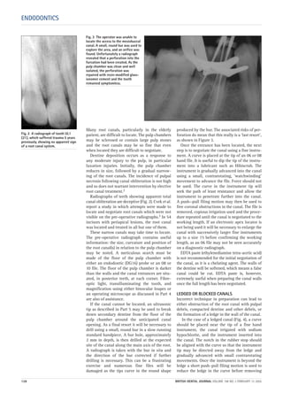 Fig. 2 A radiograph of tooth UL1
(21), which suffered trauma 5 years
previously, showing no apparent sign
of a root canal system.
Many root canals, particularly in the elderly
patient, are difficult to locate. The pulp chambers
may be sclerosed or contain large pulp stones
and the root canals may be so fine that even
when located they are difficult to negotiate.
Dentine deposition occurs as a response to
any moderate injury to the pulp, in particular
luxation injuries. Initially, the pulp chamber
reduces in size, followed by a gradual narrow-
ing of the root canals. The incidence of pulpal
necrosis following canal obliteration is not high
and so does not warrant intervention by elective
root canal treatment.2
Radiographs of teeth showing apparent total
canal obliteration are deceptive (Fig. 2). Cvek et al.
report a study in which attempts were made to
locate and negotiate root canals which were not
visible on the pre-operative radiographs.3 In 54
incisors with periapical lesions, the root canal
was located and treated in all but one of them.
These narrow canals may take time to locate.
The pre-operative radiograph contains useful
information: the size, curvature and position of
the root canal(s) in relation to the pulp chamber
may be noted. A meticulous search must be
made of the floor of the pulp chamber with
either an endodontic (DG16) probe or an 08 or
10 file. The floor of the pulp chamber is darker
than the walls and the canal entrances are situ-
ated, in posterior teeth, at each corner. Fibre-
optic light, transilluminating the tooth, and
magnification using either binocular loupes or
an operating microscope as discussed in Part 4
are also of assistance.
If the canal cannot be located, an ultrasonic
tip as described in Part 5 may be used to break
down secondary dentine from the floor of the
pulp chamber around the anticipated canal
opening. As a final resort it will be necessary to
drill using a small, round bur in a slow running
standard handpiece. A bur hole, approximately
2 mm in depth, is then drilled at the expected
site of the canal along the main axis of the root.
A radiograph is taken with the bur in situ and
the direction of the bur corrected if further
drilling is necessary. This can be a frustrating
exercise and numerous fine files will be
damaged as the tips curve in the round shape
produced by the bur. The associated risks of per-
foration do mean that this really is a ‘last resort’,
as shown in Figure 3.
Once the entrance has been located, the next
step is to negotiate the canal using a fine instru-
ment. A curve is placed at the tip of an 06 or 08
hand file. It is useful to dip the tip of the instru-
ment into a lubricant such as Hibiscrub. The
instrument is gradually advanced into the canal
using a small, contrarotating, ‘watchwinding’
movement to advance the file. Force should not
be used. The curve in the instrument tip will
seek the path of least resistance and allow the
instrument to penetrate further into the canal.
A push—pull filing motion may then be used to
free coronal obstructions in the canal. The file is
removed, copious irrigation used and the proce-
dure repeated until the canal is negotiated to the
working length. If an electronic apex locator is
not being used it will be necessary to enlarge the
canal with successively larger fine instruments
up to a size 15 before confirming the working
length, as an 06 file may not be seen accurately
on a diagnostic radiograph.
EDTA paste (ethylenediamine tetra-acetic acid)
is not recommended for the initial negotiation of
the canal, as it is a chelating agent. The walls of
the dentine will be softened, which means a false
canal could be cut. EDTA paste is, however,
extremely useful when preparing the canal walls
once the full length has been negotiated.
LEDGED OR BLOCKED CANALS
Incorrect technique in preparation can lead to
either obstruction of the root canal with pulpal
debris, compacted dentine and other debris, or
the formation of a ledge in the wall of the canal.
In the case of a ledged canal (Fig. 4), a curve
should be placed near the tip of a fine hand
instrument, the canal irrigated with sodium
hypochlorite, and the instrument inserted into
the canal. The notch in the rubber stop should
be aligned with the curve so that the instrument
tip may be directed away from the ledge and
gradually advanced with small contrarotating
movements. Once the instrument is beyond the
ledge a short push–pull filing motion is used to
reduce the ledge in the curve before removing
ENDODONTICS
Fig. 3 The operator was unable to
locate the access to the mesiobuccal
canal. A small, round bur was used to
explore the area, and an orifice was
found. Unfortunately a radiograph
revealed that a perforation into the
furcation had been created. As the
pulp chamber was clean and well
isolated, the perforation was
repaired with resin-modified glass-
ionomer cement and the tooth
remained symptomless.
128 BRITISH DENTAL JOURNAL VOLUME 198 NO. 3 FEBRUARY 12 2005
3p127-133.qxd 19/01/2005 13:31 Page 128
 