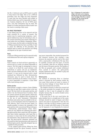 Fig. 5 This tooth has been root filled
using both silver points and gutta-
percha. The operator must be able to
distinguish between various root-
filling materials by their
radiographic appearance.
the file. A lubricant such as EDTA paste is useful
to help remove the ledge. This is not a difficult
procedure once the ledge has been bypassed.
A canal that has been blocked with pulpal or
dentine debris may well be impossible to negoti-
ate. Copious irrigation, the use of EDTA paste
and a very fine instrument may be tried. The
danger is of either packing the debris harder into
the canal or creating a false canal.
RE-ROOT TREATMENT
A root filling may have to be removed and the
tooth retreated for a variety of reasons. The
patient may be experiencing symptoms, a peri-
apical radiolucency may be increasing in size, or
the coronal restoration may require replacing in a
tooth where the root filling is inadequate. What-
ever the reason, the first step is to identify the type
of filling material that has been used (Fig. 5) and
to assess the difficulty of the procedure. The
method used to remove the previous root filling
will depend on the type of material used.
Paste
A soft root-filling material may be removed easily
with Hedstroem files and copious irrigation.
Cement
Some cements set hard and have apparently no
solvent and, as a result, are almost impossible to
remove. The first stage in attempting to remove
a cement is to flood the canal entrance with
chloroform or xylene and use an endodontic
probe and then Hedstroem files. If this fails, the
coronal 2–3 mm can be removed with a small
rosehead bur followed by files. Alternatively,
ultrasonics may be used to break down the
cement and flush out the debris. It may, howev-
er, prove impossible to negotiate a canal filled
with a hard setting cement.
Gutta-percha
Gutta-percha is simple to remove. Gates–Glidden
burs may be used first to gain access to the root
canal. The burs both cut away gutta-percha, and
soften it by the frictional heat of rotation. There
are various solvents for gutta-percha, which may
be dispensed into a Dappens dish and picked up
on the tip of each instrument. Chloroform,
halothane and xylene may be available in the sur-
gery, or oil of eucalyptus and oil of turpentine are
both effective. Once access has been made it is
usually possible to remove the remainder of the
gutta-percha with conventional filing techniques.
Alternatively, nickel-titanium rotary instru-
ments are very efficient for softening and remov-
ing gutta-percha from canals that will accommo-
date them. Initial exploration with hand files is
necessary to create room for the cutting flutes of
the instruments. They should not be used to path-
find. The piezo-electric ultrasonic machines are
also useful as their heat generation aids removal of
softened gutta-percha. Specially designed tips are
available for this procedure.
If the original gutta-percha filling has been
extended beyond the apical foramen, removal
may prove impossible. One method proposed for
this situation involves first creating a gap
between the material and the wall of the canal
with a canal probe. A Hedstroem file may then
be carefully ‘screwed’ into the space. A second
and, if possible, third file are similarly inserted
into the mass of the gutta-percha. The handles of
the files are grasped, and a steady withdrawal
force exerted to remove the gutta-percha
point(s). Hedstroem files are needed to grip and
pull back the gutta-percha.
Metal points
The method of removing silver or titanium
points is dictated by their position within the
root canal. Silver points are easier to remove if
there has been leakage of tissue fluids into the
canal and corrosion has occurred.
The simplest situation is when the coronal end
of the point protrudes far enough into the pulp
chamber so that it may be grasped by either
Steiglitz forceps (Fig. 6), narrow-beaked artery
forceps or fine pliers.
If the point lies in the root canal below the
pulp chamber but in a straight part of the canal,
attempts should be made to bypass and either
remove the point or incorporate it into the root
filling. A size 08 or 10 file or reamer is used, and
the tip is coated with EDTA paste. If the point
can be bypassed, it can frequently be removed
ENDODONTIC PROBLEMS
Fig. 4 A diagram of a canal with a
ledge in the outer curve, showing
how the tip of a pre-curved file may
enter the ledge. If the file is rotated
through 180° the curved tip will
follow the original canal.
BRITISH DENTAL JOURNAL VOLUME 198 NO. 3 FEBRUARY 12 2005 129
3p127-133.qxd 19/01/2005 13:31 Page 129
 