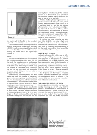 tor must weigh the benefits of this procedure
against the damage to the trepan.
A fractured instrument remaining in a canal
does not mean that the attempt at root treatment
will fail. It has been demonstrated that, provided
the remainder of the root canal is filled conven-
tionally, the success rate is not significantly
affected.5,6
POSTS
A post may have to be removed because either
the tooth requires (re)root filling or the post has
fractured. The procedure presents problems as
there is a danger of fracturing or perforating the
root of the tooth. Threaded posts which have
fractured can be removed by cutting a groove in
the post end and unscrewing. It is possible to
extract a smooth-sided post and core using a
post extractor (Fig. 10).
A piezo-electric ultrasonic system, used with
special tips, should first be used at the appropriate
power setting. Moving the tips around the base of
the post at moderate power will remove cement
around the post. A different tip may then be used
to apply maximum vibratory energy to the post in
an attempt to vibrate the post loose directly.
With the Eggler system, the core must first be
shaped so that its sides are parallel and capable
of being gripped. The mesial and distal shoulders
of the crown preparation must be cut to the same
height so there is no torsional force. The post
extractor is then placed over the post and the
screw tightened onto the core; the feet are then
lowered on to the shoulders of the preparation
by turning the end knob. Several more turns will
ease the post out of the post hole.
With the Ruddle system, a trephine is used to
produce a parallel side in the post, which is then
grasped in a matching sized thread cutting tap to
a maximum depth of 3 mm. The post removal
pliers are placed over a rubber cushion, and gen-
tly tightened. If removal is difficult, further
ultrasonic energy may be applied. As with all
such instruments, there is a danger of root frac-
ture, and expertise should be gained in a techni-
cal laboratory before attempting these tech-
niques in a clinical situation.
A fractured post lying within the root canal
may either be drilled out using a high-speed
handpiece, which is a hazardous procedure, or
removed with a Masserann kit as described ear-
lier. Figure 11 shows the initial radiograph of
the fractured post, and the item successfully
removed with the Masseran kit.
VERTICAL ROOT FRACTURE
Although infrequent, this problem may be diffi-
cult to diagnose. The patient may present with
mild symptoms, or it may appear that the root
canal treatment has not been successful. Cases
have been reported where the first indication of
a vertical root fracture has been when a muco-
periosteal flap has been raised to carry out peri-
radicular surgery on an apparently persistent
lesion. Figure 12 in Part 2 shows a tooth with
such a fracture which had to be extracted.
The diagnosis can, however, be suspected
when a radiograph shows bone loss extending
all around a root or a tooth, as in Figure 12. The
vertical defect has led to bacterial contamina-
tion of the entire tooth surface.
THE DISCOLORED ROOT-FILLED TOOTH
Bleaching and tooth-whitening procedures are
rapidly becoming a part of every dentist’s
practice. The routine use of such materials in
restorative dentistry is outside the scope of this
text, and the subject is comprehensively cov-
ered in other books.7,8 However, teeth which
have been root filled may darken for various
Fig. 12 A radiograph of a molar
with a vertical root fracture,
showing the pathognomonic
appearance of periodontitis
surrounding the entire root.
ENDODONTIC PROBLEMS
Fig. 11 A fractured post successfully removed with the
Masseran kit.
BRITISH DENTAL JOURNAL VOLUME 198 NO. 3 FEBRUARY 12 2005 131
3p127-133.qxd 19/01/2005 13:33 Page 131
 