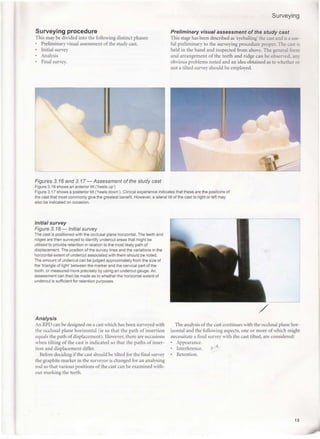 Surveying Study Cast Rpd A clinical guide_to_removable_partial_denture_design | PDF