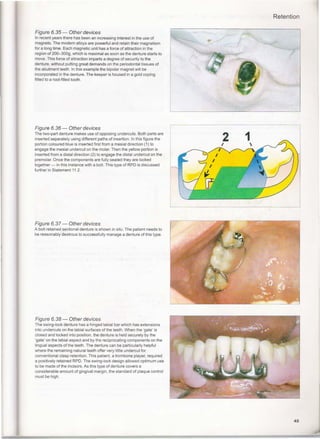 A clinical guide_to_removable_partial_denture_design | PDF